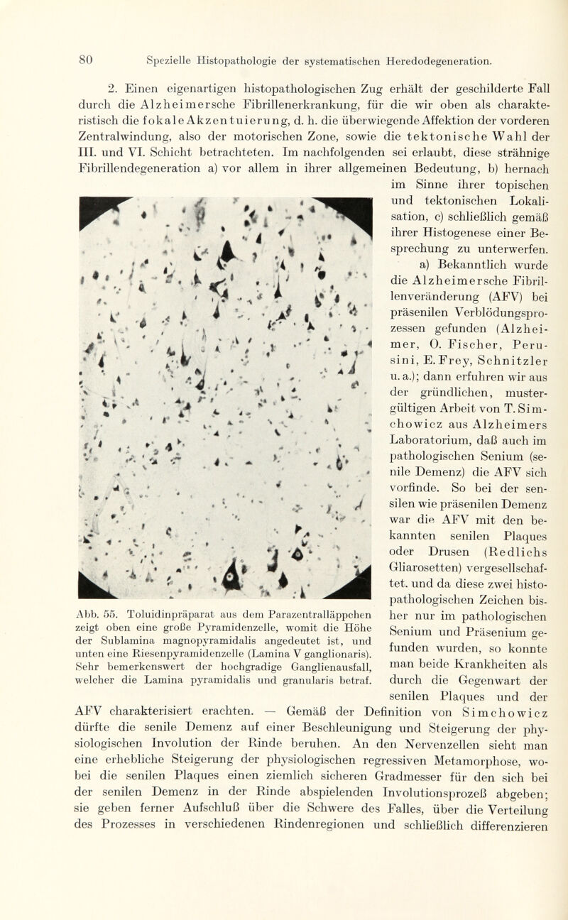 80 Spezielle Histopathologie der systematischen Heredodegeneration. » •• ? I ; ä à 4 i-* i i 1 ? ^ i - ? . . ? ♦ л * t л V *•» i' > ! #• > « ^ é '» ' f * 1. » . a. 4.. Í 4 » . 0 f- .i 4 Ф \ % 'i 2. Einen eigenartigen histopathologischen Zug erhält der geschilderte Fall durch die Alzheimersche Fibrillenerkrankung, für die wir oben als charakte¬ ristisch die fokaleAkzentuierung, d. h. die überwiegende Affektion der vorderen Zentralwindung, also der motorischen Zone, sowie die tektonische Wahl der III. und VI. Schicht betrachteten. Im nachfolgenden sei erlaubt, diese strähnige Fibrillendegeneration a) vor allem in ihrer allgemeinen Bedeutung, b) hernach im Sinne ihrer topischen und tektonischen Lokali¬ sation, c) schließlich gemäß ihrer Histogenese einer Be¬ sprechung zu unterwerfen. a) Bekanntlich wurde die Alzheimersche Fibril- lenveränderung (AFV) bei präsenilen Verblödungspro¬ zessen gefunden (Alzhei¬ mer, 0. Fischer, Peru¬ sini, E.Frey, Schnitzler u.a.); dann erfuhren wir aus der gründlichen, muster¬ gültigen Arbeit von T. Sim- chowicz aus Alzheimers Laboratorium, daß auch im pathologischen Senium (se¬ nile Demenz) die AFV sich vorfinde. So bei der sen- silen wie präsenilen Demenz war die AFV mit den be¬ kannten senilen Plaques oder Drusen (Redlichs Gliarosetten) vergesellschaf¬ tet. und da diese zwei histo¬ pathologischen Zeichen bis¬ her nur im pathologischen Senium und Präsenium ge¬ funden wurden, so konnte man beide Krankheiten als durch die Gegenwart der senilen Plaques und der AFV charakterisiert erachten. — Gemäß der Definition von Simchowicz dürfte die senile Demenz auf einer Beschleunigung und Steigerung der phy¬ siologischen Involution der Rinde beruhen. An den Nervenzellen sieht man eine erhebliche Steigerung der physiologischen regressiven Metamorphose, wo¬ bei die senilen Plaques einen ziemlich sicheren Gradmesser für den sich bei der senilen Demenz in der Rinde abspielenden Involutionsprozeß abgeben; sie geben ferner Aufschluß über die Schwere des Falles, über die Verteilung des Prozesses in verschiedenen Rindenregionen und schließlich differenzieren * ät Ч * ^ а ■•V, 4 к 9: 7^ 'tk 3 V W 4' :k' 'if/ Abb. 55. Toluidinpräparat aus dem Parazentralläppchen zeigt oben eine große Pyramidenzelle, womit die Höhe der Sublamina magnopyramidalis angedeutet ist, und unten eine Riesenpyramidenzelle (Lamina V ganglionaris). Sehr bemerkenswert der hochgradige Ganglienausfall, welcher die Lamina pyramidalis und granularis betraf.