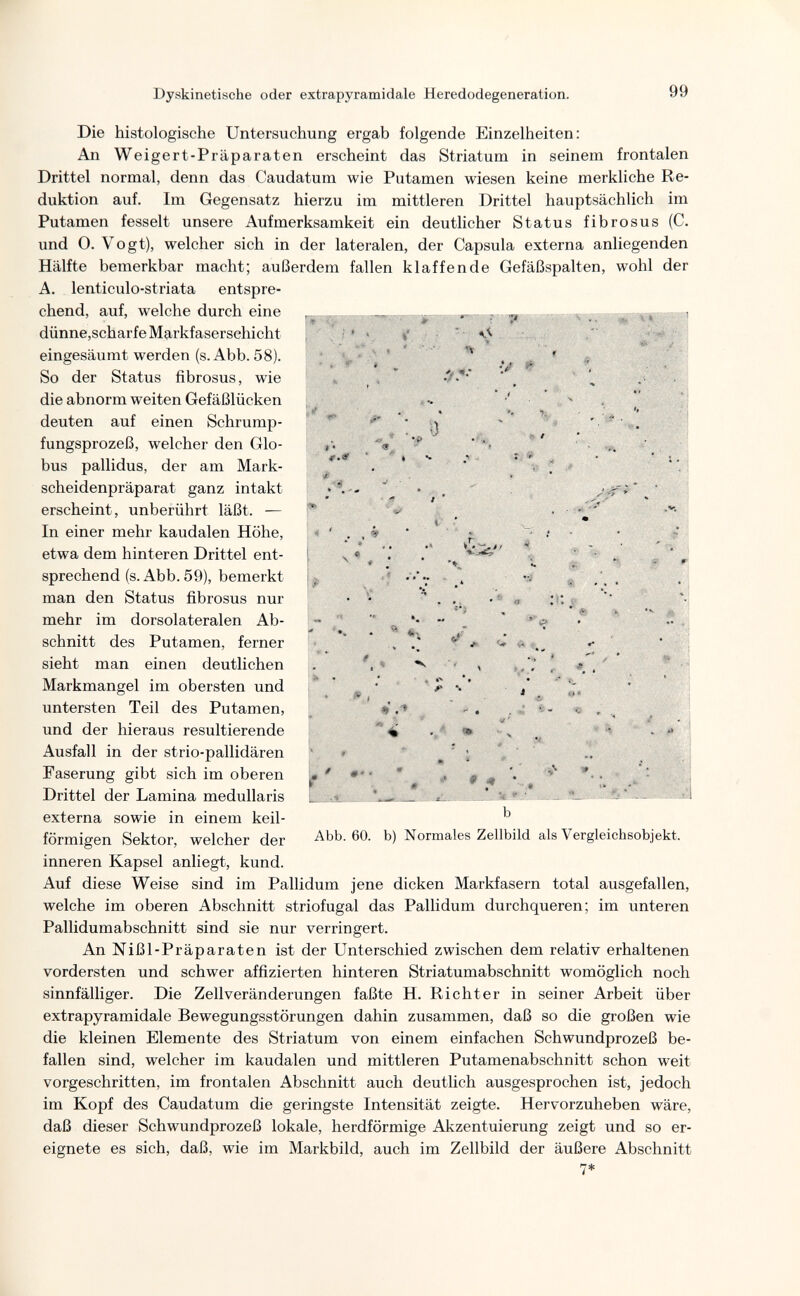 Dyskinetische oder extrapyramidale Heredodegeneration. 99 '7 Л » » . О /- • f 1?^ ^ f . » iìf i- V^' ♦•} J? :n ^ « Die histologische Untersuchung ergab folgende Einzelheiten: An Weigert-Präparaten erscheint das Striatum in seinem frontalen Drittel normal, denn das Caudatum wie Putamen wiesen keine merkliche Re¬ duktion auf. Im Gegensatz hierzu im mittleren Drittel hauptsächlich im Putamen fesselt unsere Aufmerksamkeit ein deutlicher Status fibrosus (C. und 0. Vogt), welcher sich in der lateralen, der Capsula externa anliegenden Hälfte bemerkbar macht; außerdem fallen klaffende Gefäßspalten, wohl der A. lenticulo-striata entspre¬ chend, auf, welche durch eine dünne,scharfe Markfaserschicht eingesäumt werden (s. Abb. 58). So der Status fibrosus, wie die abnorm weiten Gefäßlücken deuten auf einen Schrump¬ fungsprozeß, welcher den Glo¬ bus pallidus, der am Mark¬ scheidenpräparat ganz intakt erscheint, unberührt läßt. — In einer mehr kaudalen Höhe, etwa dem hinteren Drittel ent¬ sprechend (s. Abb. 59), bemerkt man den Status fibrosus nur mehr im dorsolateralen Ab¬ schnitt des Putamen, ferner sieht man einen deutlichen Markmangel im obersten und untersten Teil des Putamen, und der hieraus resultierende Ausfall in der strio-pallidären Faserung gibt sich im oberen Drittel der Lamina medullaris externa sowie in einem keil¬ förmigen Sektor, welcher der inneren Kapsel anliegt, kund. Auf diese Weise sind im Pallidum jene dicken Markfasern total ausgefallen, welche im oberen Abschnitt striofugal das Pallidum durchqueren; im unteren Pallidumabschnitt sind sie nur verringert. An Nißl-Präparaten ist der Unterschied zwischen dem relativ erhaltenen vordersten und schwer affizierten hinteren Striatumabschnitt womöglich noch sinnfälliger. Die Zellveränderungen faßte H. Richter in seiner Arbeit über extrapyramidale Bewegungsstörungen dahin zusammen, daß so die großen wie die kleinen Elemente des Striatum von einem einfachen Schwundprozeß be¬ fallen sind, welcher im kaudalen und mittleren Putamenabschnitt schon weit vorgeschritten, im frontalen Abschnitt auch deutlich ausgesprochen ist, jedoch im Kopf des Caudatum die geringste Intensität zeigte. Hervorzuheben wäre, daß dieser Schwundprozeß lokale, herdförmige Akzentuierung zeigt und so er¬ eignete es sich, daß, wie im Markbild, auch im Zellbild der äußere Abschnitt <* Й • Л -# » • л 9 4 'ж. b ' Abb. 60. b) Normales Zellbild als Vergleichsobjekt.