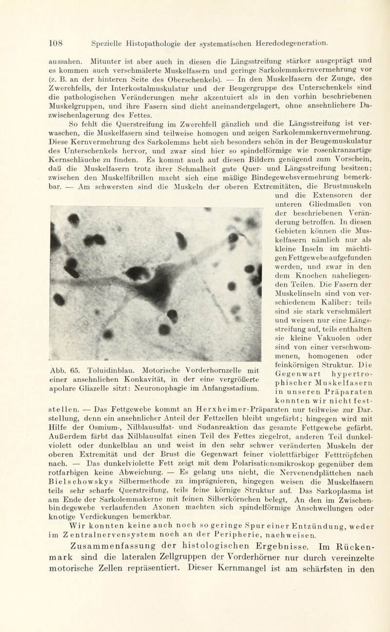 108 Spezielle Histopathologie der systematischen Heredodegeneration. aussahen. Mitunter ist aber auch in diesen die Längsstreifung stärker ausgeprägt und es kommen auch verschmälerte Muskelfasern und geringe Sarkolemmkernvermehrung vor (z. B. an der hinteren Seite des Oberschenkels). — In den Muskelfasern der Zunge, des Zwerchfells, der Interkostalmuskulatur und der Beugergruppe des Unterschenkels sind die pathologischen Veränderungen mehr akzentuiert als in den vorhin beschriebenen Muskelgruppen, und ihre Fasern sind dicht aneinandergelagert, ohne ansehnlichere Da- zwischenlagerung des Fettes. So fehlt die Querstreifung im Zwerchfell gänzlich und die Längsstreifung ist ver¬ waschen, die Muskelfasern sind teilweise homogen und zeigen Sarkolemmkernvermehrung. Diese Kernvermehrung des Sarkolemms hebt sich besonders schön in der Beugemuskulatur des Unterschenkels hervor, und zwar sind hier so spindelförmige wie rosenkranzartige Kernschläuche zu finden. Es kommt auch auf diesen Bildern genügend zum Vorschein, daß die Muskelfasern trotz ihrer Schmalheit gute Quer- und Längsstreifung besitzen; zwischen den Muskelfibrillen macht sich eine mäßige Bindegewebsvermehrung bemerk¬ bar. .— Am schwersten sind die Muskeln der oberen Extremitäten, die Brustmuskeln stellen. — Das Fettgewebe kommt an Herxheimer-Präparaten nur teilweise zur Dar¬ stellung, denn ein ansehnlicher Anteil der Fettzellen bleibt ungefärbt; hingegen wird mit Hilfe der Osmium-, Nilblausulfät- und Sudanreaktion das gesamte Fettgewebe gefärbt. Außerdem färbt das Nilblausulfat einen Teil des Fettes ziegelrot, anderen Teil dunkel¬ violett oder dunkelblau an und weist in den sehr schwer veränderten Muskeln der oberen Extremität und der Brust die Gegenwart feiner violettfärbiger Fetttröpfchen nach. — Das dunkelviolette Fett zeigt mit dem Polarisationsmikroskop gegenüber dem rotfarbigen keine Abweichung. — Es gelang uns nicht, die Nervenendplättchen nach Bielschowskys Silbermethode zu imprägnieren, hingegen weisen die Muskelfasern teils sehr scharfe Querstreifung, teils feine körnige Struktur auf. Das Sarkoplasma ist am Ende der Sarkolemmakerne mit feinen Silberkörnchen belegt. An den im Zwischen¬ bindegewebe verlaufenden Axonen machten sich spindelförmige Anschwellungen oder knotige Verdickungen bemerkbar. Wir konnten keine auch noch so geringe Spur einer Entzündung, weder im Zentralnervensystem noch an der Peripherie, nachweisen. Zusammenfassung der histologischen Ergebnisse. Im Rücken¬ mark sind die lateralen Zellgruppen der Vorderhörner nur durch vereinzelte motorische Zellen repräsentiert. Dieser Kernmangel ist am schärfsten in den Abb. 65. Toluidinblau. Motorische Vorderhornzelle mit einer ansehnlichen Konkavität, in der eine vergrößerte apolare Gliazelle sitzt: Neuronophagie im Anfangsstadium. und die Extensoren der unteren Gliedmaßen von der beschriebenen Verän¬ derung betroffen. In diesen Gebieten können die Mus¬ kelfasern nämlich nur als kleine Inseln im mächti¬ gen Fettgewebe aufgefunden werden, und zwar in den dem Knochen naheliegen¬ den Teilen. Die Fasern der Muskelinseln sind von ver¬ schiedenem Kaliber: teils sind sie stark verschmälert und weisen nur eine Längs¬ streifung auf, teils enthalten sie kleine Vakuolen oder sind von einer verschwom¬ menen, homogenen oder feinkörnigen Struktur. Die Gegenwart hypertro¬ phischer Muskelfasern in unseren Präparaten konnten wir nicht fest-