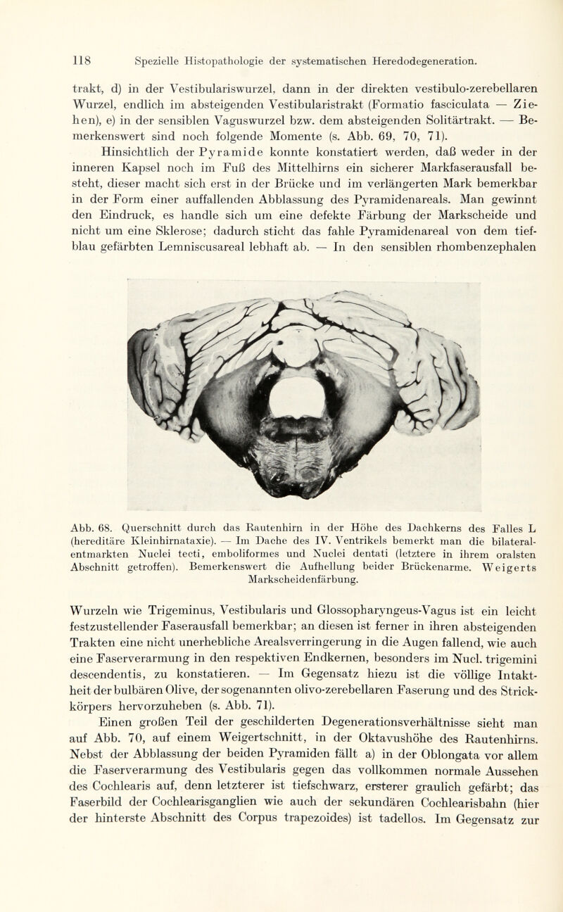 118 Spezielle Histopathologie der systematischen Heredodegeneration. trakt, d) in der Vestibulariswurzel, dann in der direkten vestibulo-zerebellaren Wurzel, endlich im absteigenden Vestibularistrakt (Formatio fasciculata — Zie¬ hen), e) in der sensiblen Vaguswurzel bzw. dem absteigenden Solitärtrakt. — Be¬ merkenswert sind noch folgende Momente (s. Abb. 69, 70, 71). Hinsichtlich der Pyramide konnte konstatiert werden, daß weder in der inneren Kapsel noch im Fuß des Mittelhirns ein sicherer Markfaserausfall be¬ steht, dieser macht sich erst in der Brücke und im verlängerten Mark bemerkbar in der Form einer auffallenden Abblassung des Pyramidenareals. Man gewinnt den Eindruck, es handle sich um eine defekte Färbung der Markscheide und nicht um eine Sklerose; dadurch sticht das fahle Pyramidenareal von dem tief¬ blau gefärbten Lemniscusareal lebhaft ab. — In den sensiblen rhombenzephalen Abb. 68. Querschnitt durch das Rautenhirn in der Höhe des Dachkerns des Falles L (hereditäre Kleinhirnataxie). — Im Dache des IV. Ventrikels bemerkt man die bilateral- entmarkten Nuclei tecti, emboliformes und Nuclei dentati (letztere in ihrem oralsten Abschnitt getroffen). Bemerkenswert die Aufhellung beider Brückenarme. Weigerte Markscheidenfärbung. Wurzeln wie Trigeminus, Vestibularis und Glossopharyngeus-Vagus ist ein leicht festzustellender Faserausfall bemerkbar; an diesen ist ferner in ihren absteigenden Trakten eine nicht unerhebliche Arealsverringerung in die Augen fallend, wie auch eine Faserverarmung in den respektiven Endkernen, besonders im Nucl. trigemini descendentis, zu konstatieren. — Im Gegensatz hiezu ist die völlige Intakt¬ heit der bulbären Olive, der sogenannten olivo-zerebellaren Faserung und des Strick¬ körpers hervorzuheben (s. Abb. 71). Einen großen Teil der geschilderten Degenerationsverhältnisse sieht man auf Abb. 70, auf einem Weigertschnitt, in der Oktavushöhe des Rautenhirns. Nebst der Abblassung der beiden Pyramiden fällt a) in der Oblongata vor allem die Faserverarmung des Vestibularis gegen das vollkommen normale Aussehen des Cochlearis auf, denn letzterer ist tiefschwarz, ersterer graulich gefärbt; das Faserbild der Cochlearisganglien wie auch der sekundären Cochlearisbahn (hier der hinterste Abschnitt des Corpus trapezoides) ist tadellos. Im Gegensatz zur