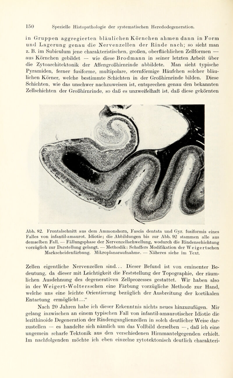 150 Spezielle Histopathologie der systematischen Heredodegeneration. in Gruppen aggregierten bläulichen Körnchen ahmen dann in Form und Lagerung genau die Nervenzellen der Rinde nach; so sieht man z. B. im Subiculum jene charakteristischen, großen, oberflächlichen Zellformen — aus Körnchen gebildet — wie diese Brodmann in seiner letzten Arbeit über die Zytoarchitektonik der Affengroßhirnrinde abbildete. Man sieht typische Pyramiden, ferner fusiforme, multipolare, sternförmige Häufchen solcher bläu¬ lichen Körner, welche bestimmte Schichten in der Großhirnrinde bilden. Diese Schichten, wie das unschwer nachzuweisen ist, entsprechen genau den bekannten Zellschichten der Großhirnrinde, so daß es unzweifelhaft ist, daß diese gekörnten Abb. 82. Frontalschnitt aus dem Ammonshorn, Fascia dentata und Gyr. fusiformis eines Falles von infantil-amaurot. Idiotie; die Abbildungen bis zur Abb. 92 stammen alle aus demselben Fall. — Fällungsphase der Nervenzellschwellung, wodurch die Rindenschichtung vorzüglich zur Darstellung gelangt. —^ Methodik: Schaffers Modifikation der Weigertschen Markscheidenfärbung. Mikroplanaraufnahme. — Näheres siehe im Text. Zellen eigentliche Nervenzellen sind... Dieser Befund ist von eminenter Be¬ deutung, da dieser mit Leichtigkeit die Feststellung der Topographie, der räum¬ lichen Ausdehnung des degenerativen Zellprozesses gestattet. Wir haben also in der Weigert-Woltersschen eine Färbung vorzügliche Methode zur Hand, welche uns eine leichte Orientierung bezüglich der Ausbreitung der kortikalen Entartung ermöglicht... Nach 20 Jahren habe ich dieser Erkenntnis nichts neues hinzuzufügen. Mir gelang inzwischen an einem typischen Fall von infant il-amaurotischer Idiotie die lezithinoide Degeneration der Rindenganglienzellen in solch deutlicher Weise dar¬ zustellen — es handelte sich nämlich um das Vollbild derselben —, daß ich eine ungemein scharfe Tektonik aus den verschiedenen Hirnmantelgegenden erhielt. Im nachfolgenden möchte ich eben einzelne zytotektonisch deutlich charakteri-