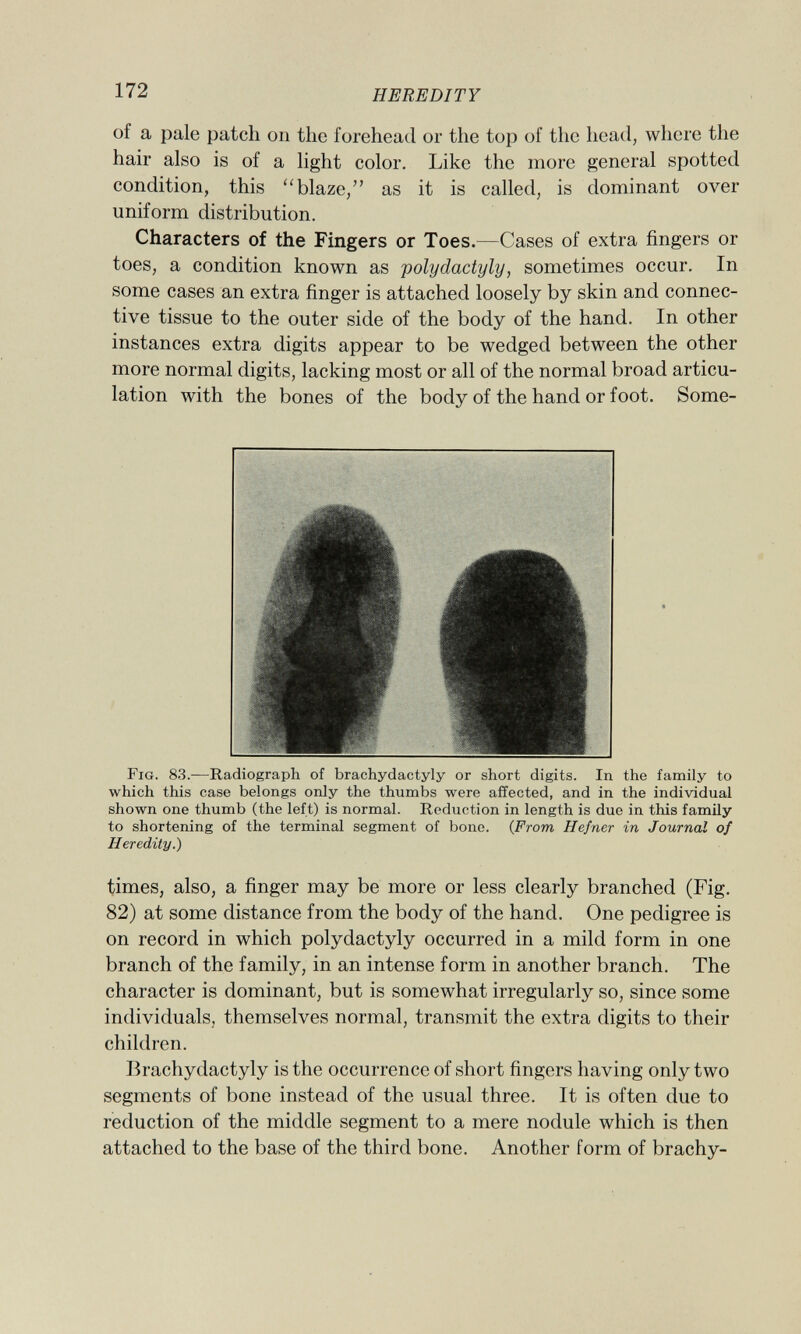 of a pale patch 011 the forehead or the top of the head, where the hair also is of a light color. Like the more general spotted condition, this blaze, as it is called, is dominant over uniform distribution. Characters of the Fingers or Toes.— Cases of extra fingers or toes, a condition known as Polydactyly, sometimes occur. In some cases an extra finger is attached loosely by skin and connec tive tissue to the outer side of the body of the hand. In other instances extra digits appear to be wedged between the other more normal digits, lacking most or all of the normal broad articu lation with the bones of the body of the hand or foot. Some- F ig . 83. —Radiograph of brachydactyly or short digits. In the family to which this case belongs only the thumbs were affected, and in the individual shown one thumb (the left) is normal. Reduction in length is due in this family to shortening of the terminal segment of bone. ( From Hefner in Journal of Heredity.) times, also, a finger may be more or less clearly branched (Fig. 82) at some distance from the body of the hand. One pedigree is on record in which Polydactyly occurred in a mild form in one branch of the family, in an intense form in another branch. The character is dominant, but is somewhat irregularly so, since some individuals, themselves normal, transmit the extra digits to their children. Brachydactyly is the occurrence of short fingers having only two segments of bone instead of the usual three. It is often due to reduction of the middle segment to a mere nodule which is then attached to the base of the third bone. Another form of brachy-