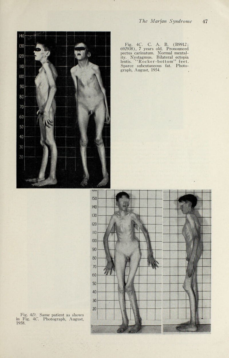 The Mar jan Syndrome 47 Fig. 4C. С. А. В. (В9912; 692938), 7 years old. Pronounced pectus carinatum. Normal mental¬ ity. Nystagmus. Bilateral ectopia lentis. Rocker-bottom'^ feet. Sparce subcutaneous fat. Photo¬ graph, August, 1954. J Fig. 4D. Same patient as shown in Fig. AC. Photograph, August, 1958.