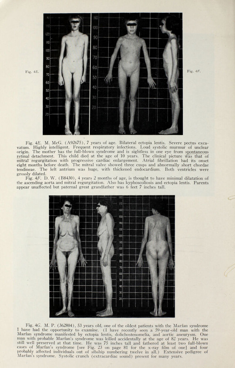 Fig. AE. M. McG. (A92675), 7 years of age. Bilateral ectopia lentis. Severe pectus exca- vatum. Highly intelligent. Frequent respiratory infections. Loud systolic murmur of unclear origin. The mother has the full-blown syndrom,e and is sightless in one eye from spontaneous retinal detachment. This child died at the age of 10 years. The clinical picture was that of mitral regurgitation with progressive cardiac enlargement. Atrial fibrillation had its onset eight months before death. The mitral valve showed three cusps and abnormally short chordae tendineae. The left antrium was huge, with thickened endocardium. Both ventricles were grossly dilated. Fig. 4F. D. W. (B8430), 4 years 2 months of age, is thought to have minimal dilatation of the ascending aorta and mitral regurgitation. Also has kyphoscoliosis and ectopia lentis. Parents appear unaffected but paternal great grandfather was 6 feet 7 inches tall. Fig. AG. M. P. (362804), 53 years old, one of the oldest patients with the Marfan syndrome I have had the opportunity to examine. (I have recently seen a 59-year-old man with the Marfan syndrome manifested by ectopia lentis, dolichostenoinelia, and aortic aneurysm. One man with probable Marfan's syndrome was killed accidentally at the age of 82 years. He was still well preserved at that time. He was 75 inches tall and fathered at least two full-blown cases of Marfan's syndrome [see Fig. 23 on page 81 for the x-ray film of one] and four probably affected individuals out of sibship numbering twelve in all.) Extensive pedigree of Marfan's syndrome. Systolic cruncli (extracardiac sound) present for many years.