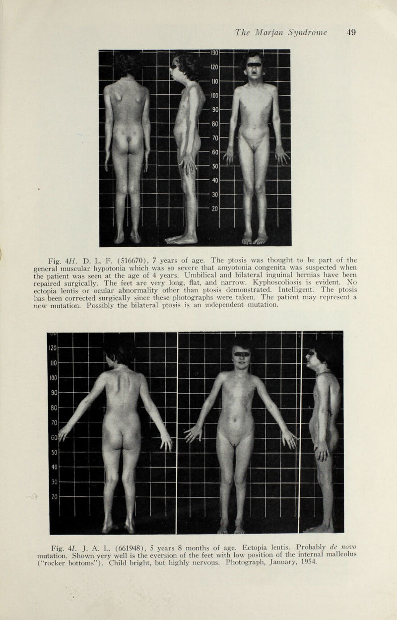 The Marfan Syndrome 49 Fig. AH. D. L. F. (516670), 7 years of age. The ptosis was thought to be part of the general muscular hypotonia which was so severe that amyotonia congenita was suspected when the patient was seen at the age of 4 years. Umbilical and bilateral inguinal hernias have been repaired surgically. The feet are very long, flat, and narrow. Kyphoscoliosis is evident. No ectopia lentis or ocular abnormality other than ptosis demonstrated. Intelligent. The ptosis has been corrected surgically since these photographs were taken. The patient may represent a new mutation. Possibly the bilateral ptosis is an independent mutation. Fig. 41. J. A. L. (661948), 5 years 8 months of age. Ectopia lentis. Probably de novo mutation. Shown very well is the eversión of the feet with low position of the internal malleolus (rocker bottoms). Child bright, but highly nervous. Photograph, January, 1954.