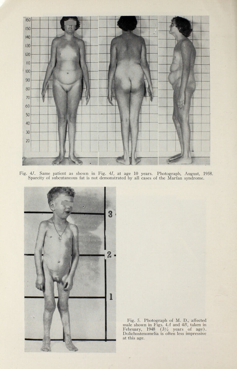 Fig. 4/. Same patient as shown in Fig. AI, at age 10 years. Photograph, August, 1958. Sparcity of subcutaneous fat is not demonstrated by all cases of the Marfan syndrome. Fig. S. Photograph of M. D., affected male shown in Figs. AA and AB, taken in February, 1948 (3^4 years of age). Dolichostenomelia is often less impressive at this age.