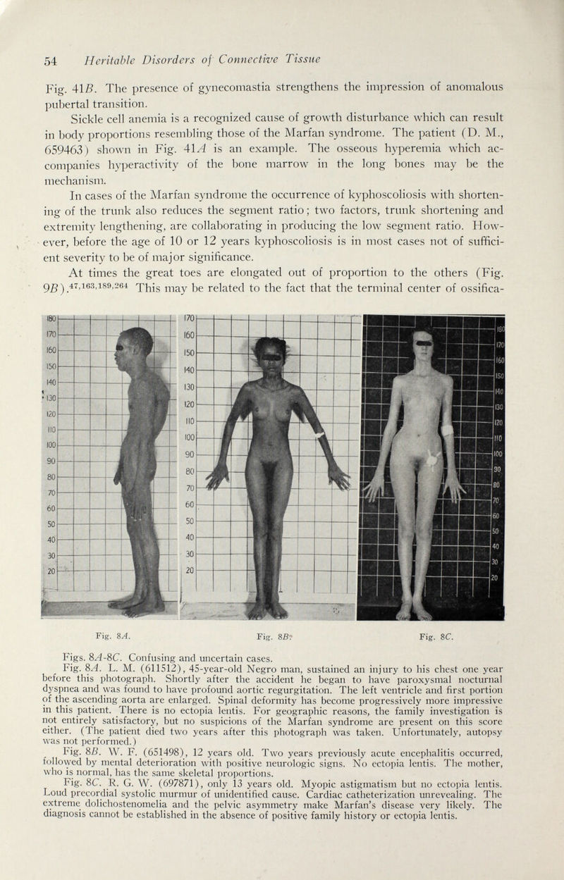 54 Heritable Disorders of Connective Tissue Fig. AlB. The presence of gynecomastia strengthens the impression of anomalous pu1)ertal transition. Sickle cell anemia is a recognized cause of growth disturbance which can result in body proportions resembling those of the Marfan syndrome. The patient (D. M., 659463) shown in Fig. A\A is an example. The osseous hyperemia which ac¬ companies hyperactivity of the bone marrow in the long bones may be the mechanism. In cases of the Marfan syndrome the occurrence of kyphoscoliosis with shorten¬ ing of the trunk also reduces the segment ratio ; two factors, trunk shortening and extremity lengthening, are collaborating in producing the low segment ratio. How¬ ever, before the age of 10 or 12 years kyphoscoliosis is in most cases not of suffici¬ ent severity to be of major significance. At times the great toes are elongated out of proportion to the others (Fig. 9ß) This may be related to the fact that the terminal center of ossifica- Fig. 8A. Fi,?. 8Sr Fig. 8C. Figs. 8A-SC. Confusing and uncertain cases. Fig. 8A. L. M. (611512), 45-year-old Negro man, sustained an injury to his chest one year before this photograph. Shortly after the accident he began to have paroxysmal nocturnal dyspnea and was found to have profound aortic regurgitation. The left ventricle and first portion of the ascending aorta are enlarged. Spinal deformity has become progressively more impressive in this patient. There is no ectopia lentis. For geographic reasons, the family investigation is not entirely satisfactory, but no suspicions of the Marfan syndrome are present on this score either. (The patient died two years after this photograph was taken. Unfortunately, autopsy was not performed.) big. SB. W. F. (651498), 12 years old. Two years previously acute encephalitis occurred, followed by mental deterioration with positive neurologic signs. No ectopia lentis. The mother, who is normal, has the same skeletal proportions. Fig. 8C. R. G. W. (697871), only 13 years old. Myopic astigmatism but no ectopia lentis. Loud precordial systolic murmur of unidentified cause. Cardiac catheterization unrevealing. The extreme dolichostenomelia and the pelvic asymmetry make Marfan's disease very likely. The diagnosis cannot be established in the absence of positive family history or ectopia lentis.