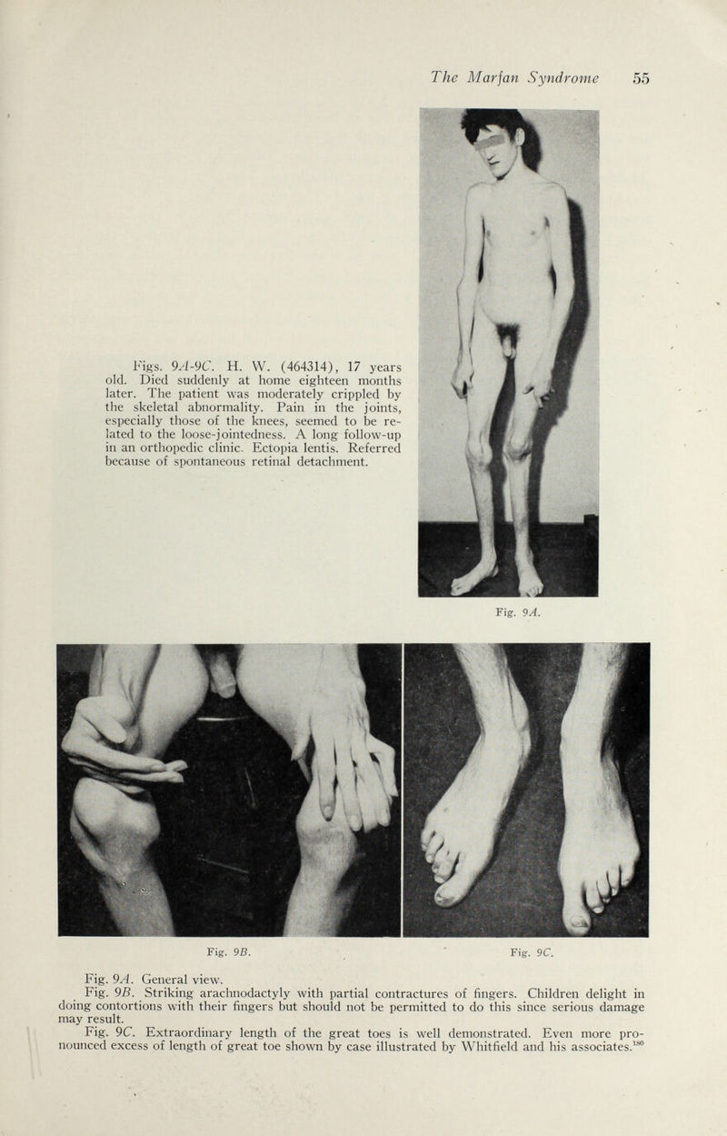 Figs. 9A-9C. H. W. (464314), 17 years old. Died suddenly at home eighteen months later. The patient was moderately crippled by the skeletal abnormality. Pain in the joints, especially those of the knees, seemed to be re¬ lated to the loose-jointedness. A long follow-up in an orthopedic clinic. Ectopia lentis. Referred because of spontaneous retinal detachment. Fig. 9A. Fig. 9B. Fig. 9C. Fig. 9A. General view. Fig. 9B. Striking arachnodactyly with partial contractures of fingers. Children delight in doing contortions with their fingers but should not be permitted to do this since serious damage may result. Fig. 9C. Extraordinary length of the great toes is well demonstrated. Even more pro¬ nounced excess of length of great toe shown by case illustrated by Whitfield and his associates.^