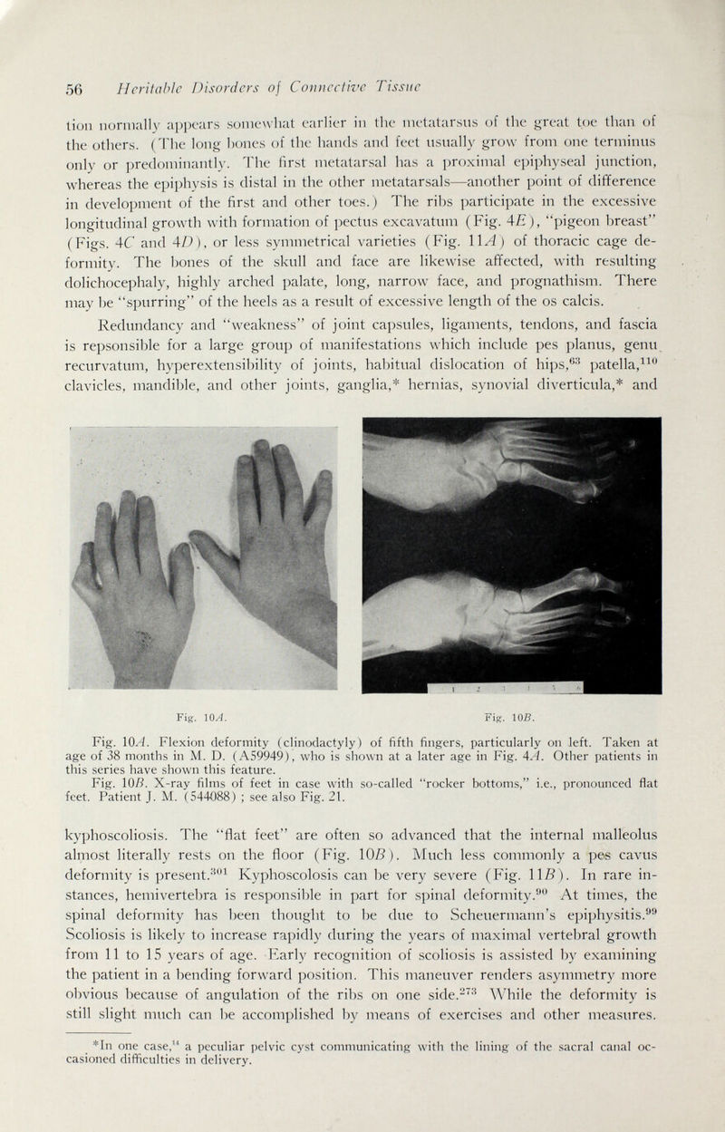 56 Heritable Disorders of Connective Tissue lion normally appears somewhat earlier in the metatarsus of the great toe than of the others. (The long bones of the hands and feet usually grow from one terminus only or predominantly. The first metatarsal has a proximal epiphyseal junction, whereas the epiphysis is distal in the other metatarsals—another point of difference in development of the first and other toes.) The ribs participate in the excessive longitudinal growth with formation of pectus excavatum (Fig. 4£), pigeon breast (Figs. 4C and 4D ), or less symmetrical varieties (Fig. \\A) of thoracic cage de¬ formity. The bones of the skull and face are likewise affected, with resulting dolichocephaly, highly arched palate, long, narrow face, and prognathism. There may be spurring of the heels as a result of excessive length of the os calcis. Redundancy and weakness of joint capsules, ligaments, tendons, and fascia is repsonsible for a large group of manifestations which include pes planus, genu recurvatum, hyperextensibility of joints, habitual dislocation of hips,^'^ patella,^^ clavicles, mandible, and other joints, ganglia,* hernias, synovial diverticula,* and Fig. lOA. Fig. IOS. Fig. lOA. Flexion deformity (cHnodactyly) of fifth fingers, particularly on left. Taken at age of 38 months in M. D. (A59949), who is shown at a later age in Fig. 4A. Other patients in this series have shown this feature. Fig. lOß. X-ray films of feet in case with so-called rocker bottoms, i.e., pronounced flat feet. Patient J. M. (544088) ; see also Fig. 21. kyphoscoliosis. The flat feet are often so advanced that the internal malleolus almost literally rests on the floor (Fig. 10Б). Much less commonly a pe-s cavus deformity is present.Kyphoscolosis can be very severe (Fig. ll.ß). In rare in¬ stances, hemivertebra is responsible in part for spinal deformity.^® At times, the spinal deformity has been thought to be due to Scheuermann's epiphysitis.'^'' Scoliosis is likely to increase rapidly during the years of maximal vertebral growth from 11 to 15 years of age. l^arly recognition of scoliosis is assisted by examining the patient in a bending forward position. This maneuver renders asymmetry more obvious because of angulation of the ribs on one side.-'^ While the deformity is still slight much can be accomplished by means of exercises and other measures. *In one case,^^ a peculiar pelvic cyst communicating with the lining of the sacral canal oc¬ casioned difficulties in delivery.