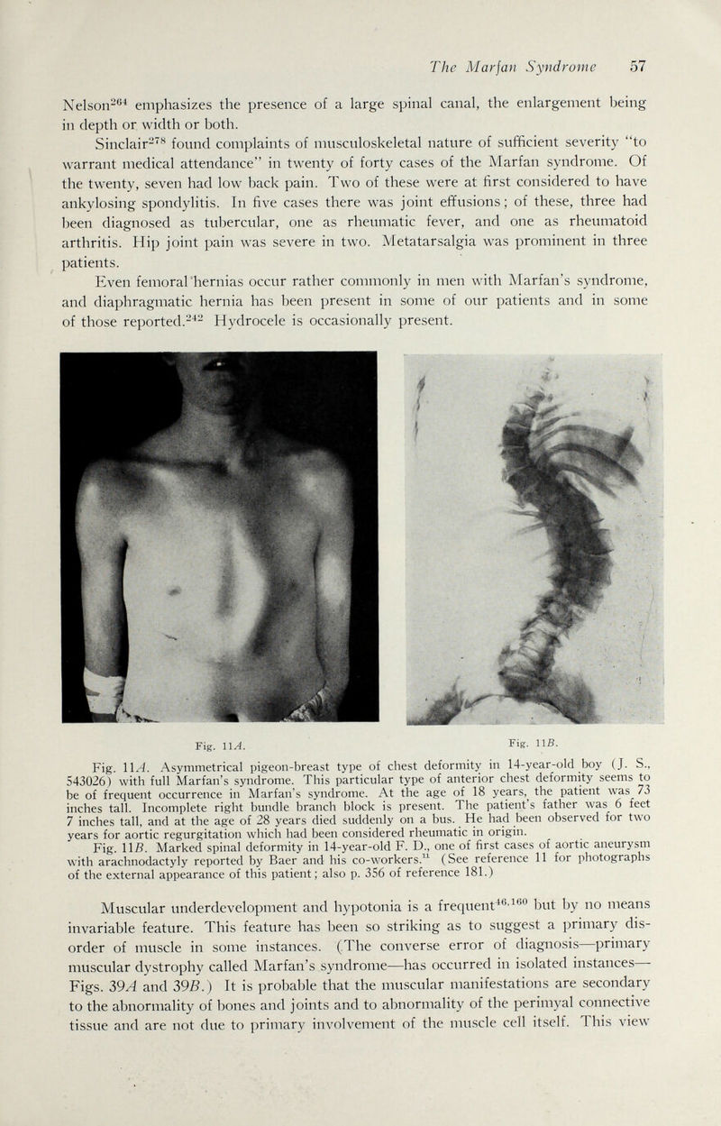 The Mar jan Syndrome 57 Nelson^^^ emphasizes the presence of a large spinal canal, the enlargement being in depth or width or both. Sinclair-''''^ found complaints of musculoskeletal nature of sufficient severity to warrant medical attendance in twenty of forty cases of the Marfan syndrome. Of the twenty, seven had low back pain. Two of these were at first considered to have ankylosing spondylitis. In five cases there was joint effusions; of these, three had been diagnosed as tubercular, one as rheumatic fever, and one as rheumatoid arthritis. Hip joint pain was severe in two. Metatarsalgia was prominent in three patients. Even femorarhernias occur rather commonly in men with Marfan's syndrome, and diaphragmatic hernia has been present in some of our patients and in some of those reported.-'- Hydrocele is occasionally present. Fig. llA. Fig. lis. Fig. IIA. Asymmetrical pigeon-breast type of chest deformity in 14-year-old boy (J. S., 543026) with full Marfan's syndrome. This particular type of anterior chest deformity seems to be of frequent occurrence in Marfan's syndrome. At the age of 18 years, the patient was 73 inches tall. Incomplete right bundle branch block is present. The patient's father was 6 feet 7 inches tall, and at the age of 28 years died suddenly on a bus. He had been observed for two years for aortic regurgitation which had been considered rheumatic in origin. Fig. \\B. Marked spinal deformity in 14-year-oId F. D., one of first cases of aortic aneurysm with arachnodactyly reported by Baer and his co-workers.'^^ (See reference 11 for photographs of the external appearance of this patient; also p. 356 of reference 181.) Muscular underdevelopment and hypotonia is a frequentbut by no means invariable feature. This feature has been so striking as to suggest a primary dis¬ order of muscle in some instances. (The converse error of diagnosis—primary muscular dystrophy called Marfan's syndrome—has occurred in isolated instances—- Figs. 39A and 39B.) It is probable that the muscular manifestations are secondary to the abnormality of bones and joints and to abnormality of the perimyal connectiA^e tissue and are not due to primary involvement of the muscle cell itself. This view
