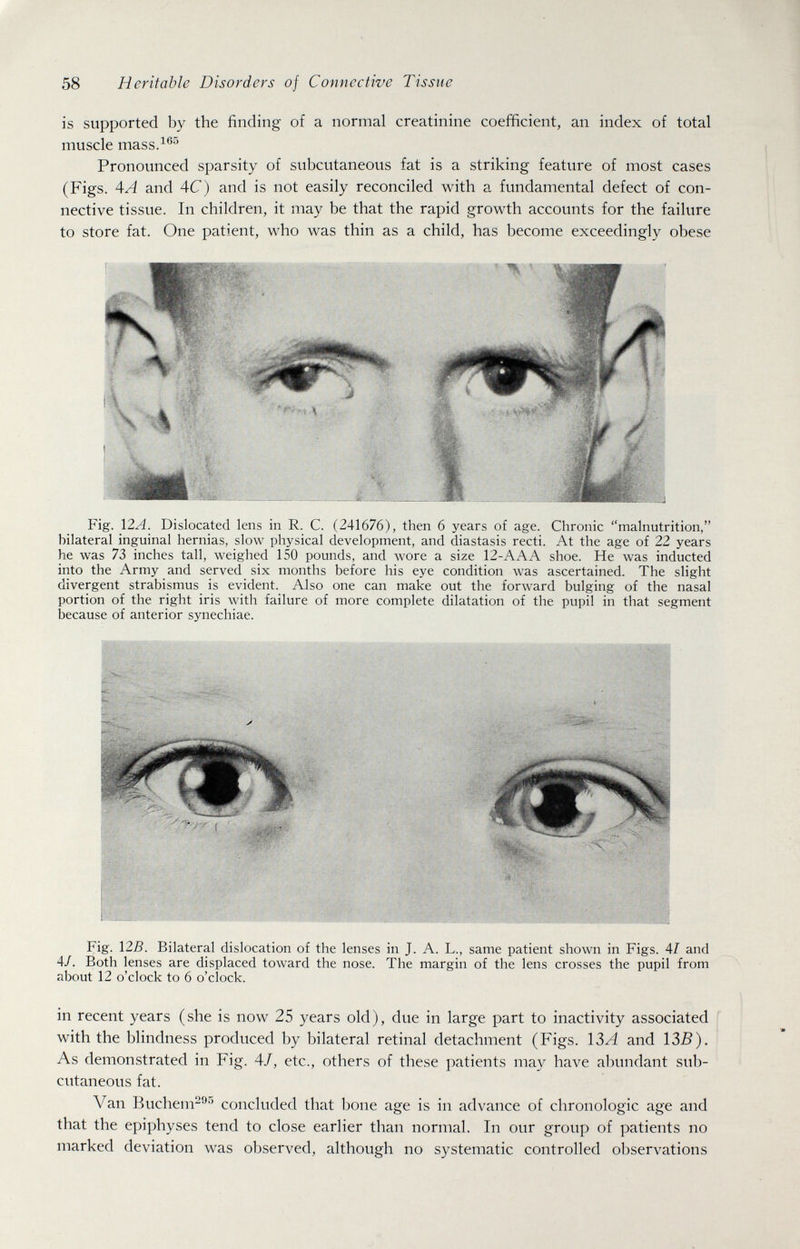 58 Heritable Disorders of Connective Tissue is supported by the finding of a normal creatinine coefficient, an index of total muscle mass.^'^'^ Pronounced sparsity of subcutaneous fat is a striking feature of most cases (Figs. A A and 4C) and is not easily reconciled with a fundamental defect of con¬ nective tissue. In children, it may be that the rapid growth accounts for the failure to store fat. One patient, who was thin as a child, has become exceedingly obese Fig. 12A. Dislocated lens in R. C. (241676), then 6 years of age. Chronic malnutrition, bilateral inguinal hernias, slow physical development, and diastasis recti. At the age of 22 years he was 73 inches tall, weighed 150 pounds, and wore a size 12-AAA shoe. He was inducted into the Army and served six months before his eye condition was ascertained. The slight divergent strabismus is evident. Also one can make out the forward bulging of the nasal portion of the right iris with failure of more complete dilatation of the pupil in that segment because of anterior synechiae. Fig. 125. Bilateral dislocation of the lenses in J. A. L., same patient shown in Figs. 41 and 4/. Both lenses are displaced toward the nose. The margin of the lens crosses the pupil from about 12 o'clock to 6 o'clock. in recent years (she is now 25 years old), due in large part to inactivity associated ^ with the blindness produced by bilateral retinal detachment (Figs. 13A and 13B). As demonstrated in Fig. 4/, etc., others of these patients may have abundant sub¬ cutaneous fat. Van Buchem^''^ concluded that bone age is in advance of chronologic age and that the epiphyses tend to close earlier than normal. In our group of patients no marked deviation was observed, although no systematic controlled observations