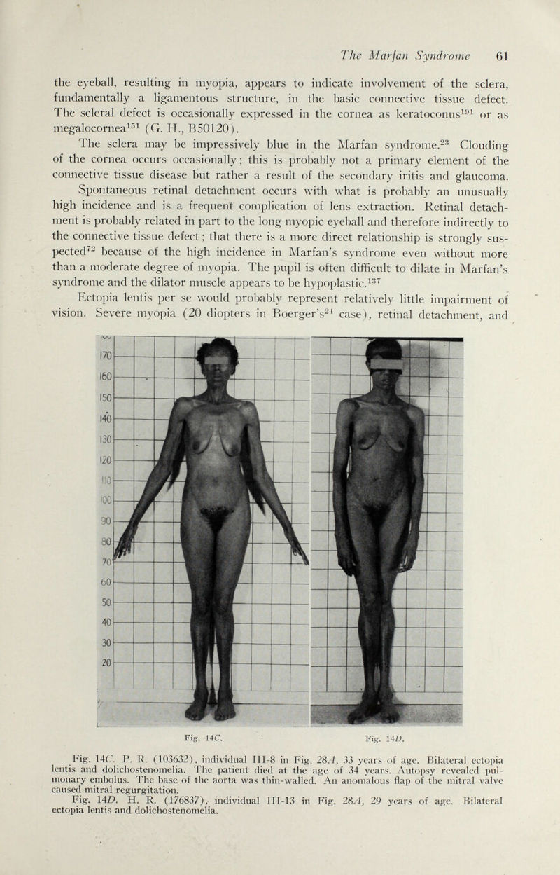 The Marfan Syndrome 61 the eyeball, resulting in myopia, appears to indicate involvement of the sclera, fundamentally a ligamentous structure, in the basic connective tissue defect. The scleral defect is occasionally expressed in the cornea as keratoconus^'^^ or as megalocornea^'''^ (G. H., B50120). The sclera may be impressively blue in the Marfan syndrome.Clouding of the cornea occurs occasionally ; this is probably not a primary element of the connective tissue disease but rather a result of the secondary iritis and glaucoma. Spontaneous retinal detachment occurs with what is probably an unusuaHy high incidence and is a frequent complication of lens extraction. Retinal detach¬ ment is probably related in part to the long myopic eyeball and therefore indirectly to the connective tissue defect ; that there is a more direct relationship is strongly sus¬ pected'- because of the high incidence in Marfan's syndrome even without more than a moderate degree of myopia. The pupil is often difficult to dilate in Marfan's syndrome and the dilator muscle appears to be hypoplastic.^'' Ectopia lentis per se w^uld probably represent relatively little impairment of vision. Severe myopia (20 diopters in Boerger's-^ case), retinal detachment, and / Fig. 14C. • Fig. 14D. Fig'. 14C. P. R. (103632), individual III-8 in Fig. 28./, 33 years of age. Bilateral ectopia lentis and dolichostenomelia. The patient died at the age of 34 years. Autopsy revealed pul¬ monary embolus. The base of the aorta was thin-walled. An anomalous flap of the mitral valve caused mitral regurgitation. Fig. 140. H. R. (176837), individual III-13 in Fig. 2%A, 29 years of age. Bilateral ectopia lentis and dolichostenomelia.