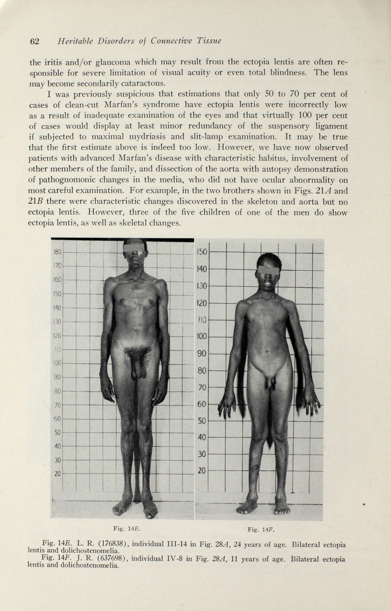 62 Heritable Disorders of Connective Tissue the iritis and/or glaucoma which may result from the ectopia lentis are often re¬ sponsible for severe limitation of visual acuity or even total blindness. The lens may become secondarily cataractous. I was previously suspicious that estimations that only 50 to 70 per cent of cases of clean-cut Marian's syndrome have ectopia lentis were incorrectly low as a result of inadequate examination of the eyes and that virtually 100 per cent of cases would display at least minor redundancy of the suspensory ligament if subjected to maximal mydriasis and slit-lamp examination. It may be true that the first estimate above is indeed too low. However, we have now observed patients with advanced Marfan's disease with characteristic habitus, involvement of other members of the family, and dissection of the aorta with autopsy demonstration of pathognomonic changes in the media, who did not have ocular abnormality on most careful examination. For example, in the two brothers shown in Figs. 21^4 and 2\B there were characteristic changes discovered in the skeleton and aorta but no ectopia lentis. However, three of the five children of one of the men do show ectopia lentis, as well as skeletal changes. 180 150 140 130 120 110 !00 90 80 70 60 50 40 30 20 Fig. UE. Fig. 14F. Fig. \AE. L. R. (176838), individual III-14 in Fig. 2d>A, 24 years of age. Bilateral ectopia lentis and dolichostenomelia. Fig. 14F. J. R. (637698), individual IV-8 in Fig. 2SA, 11 years of age. Bilateral ectopia lentis and dolichostenomelia.