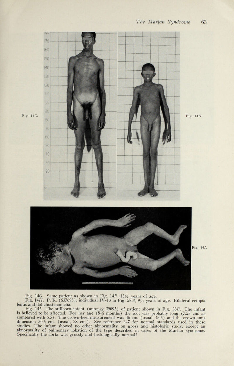 The Mar jan Syndrome 63 Fig. 14G. Same patient as shown in Fig. \AF, 15^ years of age. Fig. \AH. P. R. (637693), individual IV-13 in Fig. 28A, years of age. Bilateral ectopia lentis and dolichostenomelia. Fig. 14/. The stillborn infant (autopsy 29095) of patient shown in Fig. 285. The infant is believed to be affected. For her age (8У2 months) the foot was probably long (7.25 cm. as compared with 6.5). The crown-heel measurement was 46 cm. (usual, 43.5) and the crown-anus dimension 30.5 cm. (usual, 28 cm.). See reference 247 for normal standards used in these studies. The infant showed no other abnormality on gross and histologic study, except an abnormality of pulmonary lobation of the type described in cases of the Marfan syndrome. Specifically the aorta was grossly and histologically normal !
