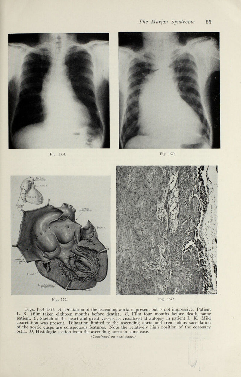The Mar jan Syndrome 65 Fig. 15^. Fig. 15B. Fig. isc Figs. 15.^-151?. A, Dilatation of the ascending aorta is present but is not impressive. Patient L. K. (film taken eighteen months before death). B, Film four months before death, same patient. C, Sketch of the heart and great vessels as visualized at autopsy in patient L. K. Mild coarctation was present. Dilatation limited to the ascending aorta and tremendous sacculation of the aortic cusps are conspicuous features. Note the relatively high position of the coronary ostia. D, Histologic section from the ascending aorta in same case. (Continued on next page.)