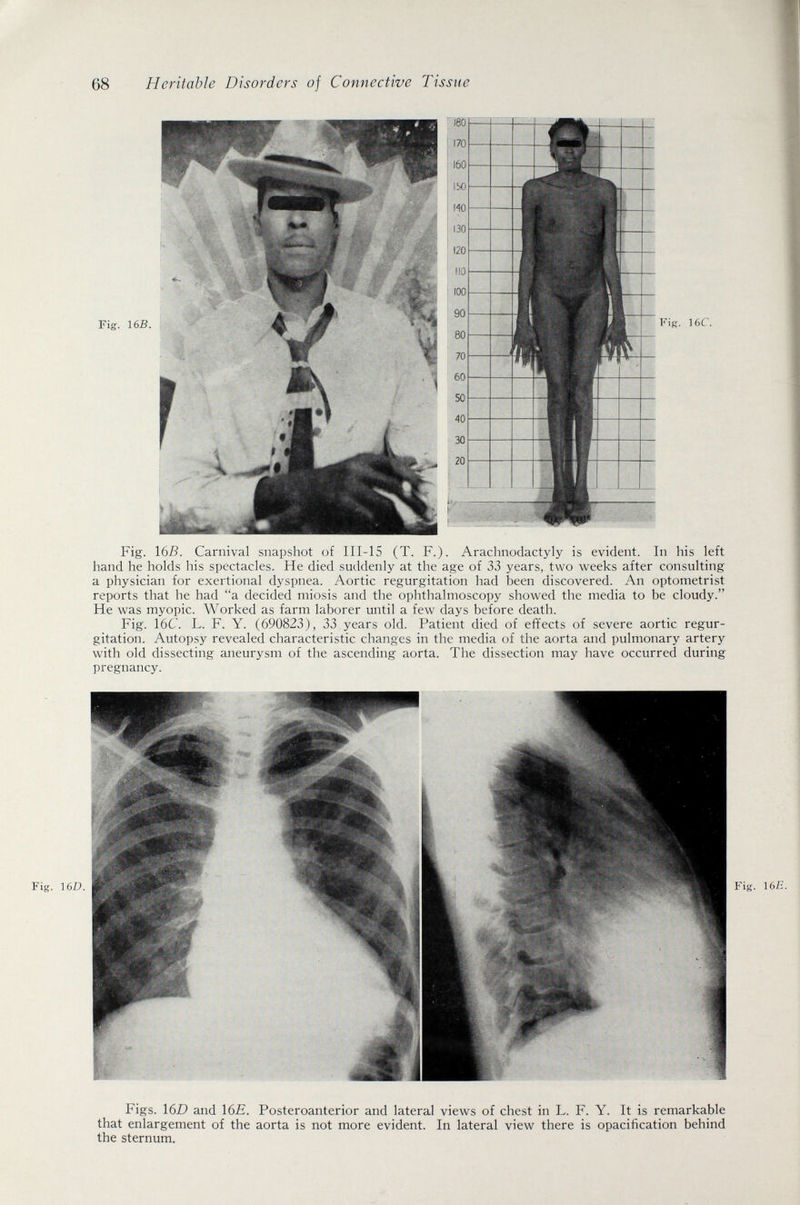68 Heritable Disorders of Connective Tissue Fig. \6B. Carnival snapshot of III-IS (T. F.)- Arachnodactyly is evident. In his left hand he holds his spectacles. He died suddenly at the age of 33 years, two weeks after consulting a physician for exertional dyspnea. Aortic regurgitation had been discovered. An optometrist reports that he had a decided miosis and the ophthalmoscopy showed the media to be cloudy. He was myopic. Worked as farm laborer until a few days before death. Fig. 16C. L. F. Y. (690823), 33 years old. Patient died of effects of severe aortic regur¬ gitation. Autopsy revealed characteristic changes in the media of the aorta and pulmonary artery with old dissecting aneurysm of the ascending aorta. The dissection may have occurred during pregnancy. Figs. leD and \вЕ. Fosteroanterior and lateral views of chest in L. F. Y. It is remarkable that enlargement of the aorta is not more evident. In lateral view there is opacification behind the sternum.
