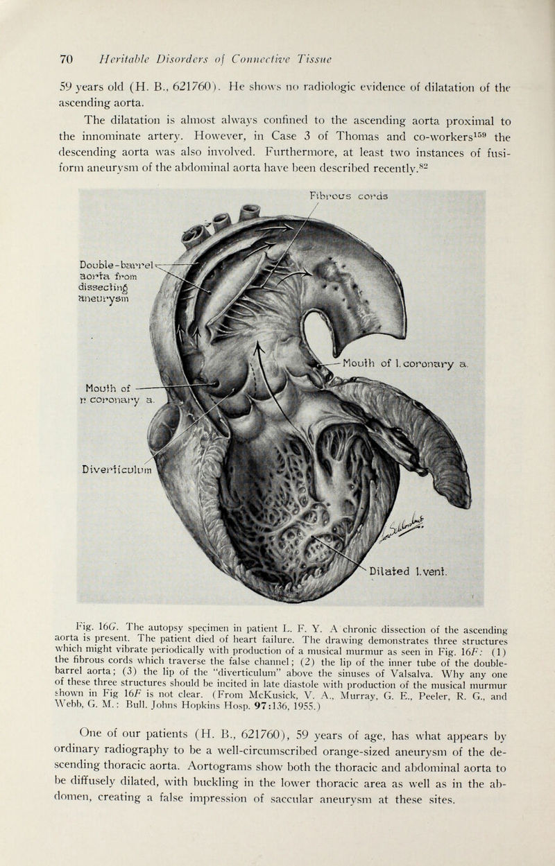 70 Heritahìe Disorders of Coimcciive llssue 59 years old (H. В., 621760). He shows no radiologic evidence of dilatation of the ascending aorta. The dilatation is almost always confined to the ascending aorta proximal to the innominate artery. However, in Case 3 of Thomas and co-workers^^ the descending aorta was also involved. Furthermore, at least two instances of fusi¬ form aneurvsm of the abdominal aorta have been described recentlv.®- Double-barrel aor>ta from dissecting aneurysm Moulh of у. coronary a. Diveríicülum Fibroas cords / Mouth of 1. coronary a. Ш. Dilated I.vent big. 16(7. The autopsy specimen in patient L. F. Y. A chronic dissection of the ascending aorta is present. The patient died of heart failure. The drawing demonstrates three structures which might vibrate periodically with production of a musical murmur as seen in Fig. \6F: (1) the fibrous cords which traverse the false channel; (2) the lip of the inner tube of the double- barrel aorta; (3) the lip of the diverticulum above the sinuses of Valsalva. Why any one of these three structures should be incited in late diastole with production of the musical murmur shown in Fig Ì6F is not clear. (From McKusick, V. A., Murray, G. E., Peeler, R. G., and W ebb, G. M. : Bull. Johns Hopkins Hosp. 97:136, 1955.) One of our patients (H. В., 621760), 59 years of age, has what appears by ordinary radiography to be a well-circumscribed orange-sized aneurysm of the de¬ scending thoracic aorta. Aortograms show both the thoracic and abdominal aorta to be diffusely dilated, with buckling in the lower thoracic area as well as in the ab¬ domen, creating a false impression of saccular aneury.sm at these sites.