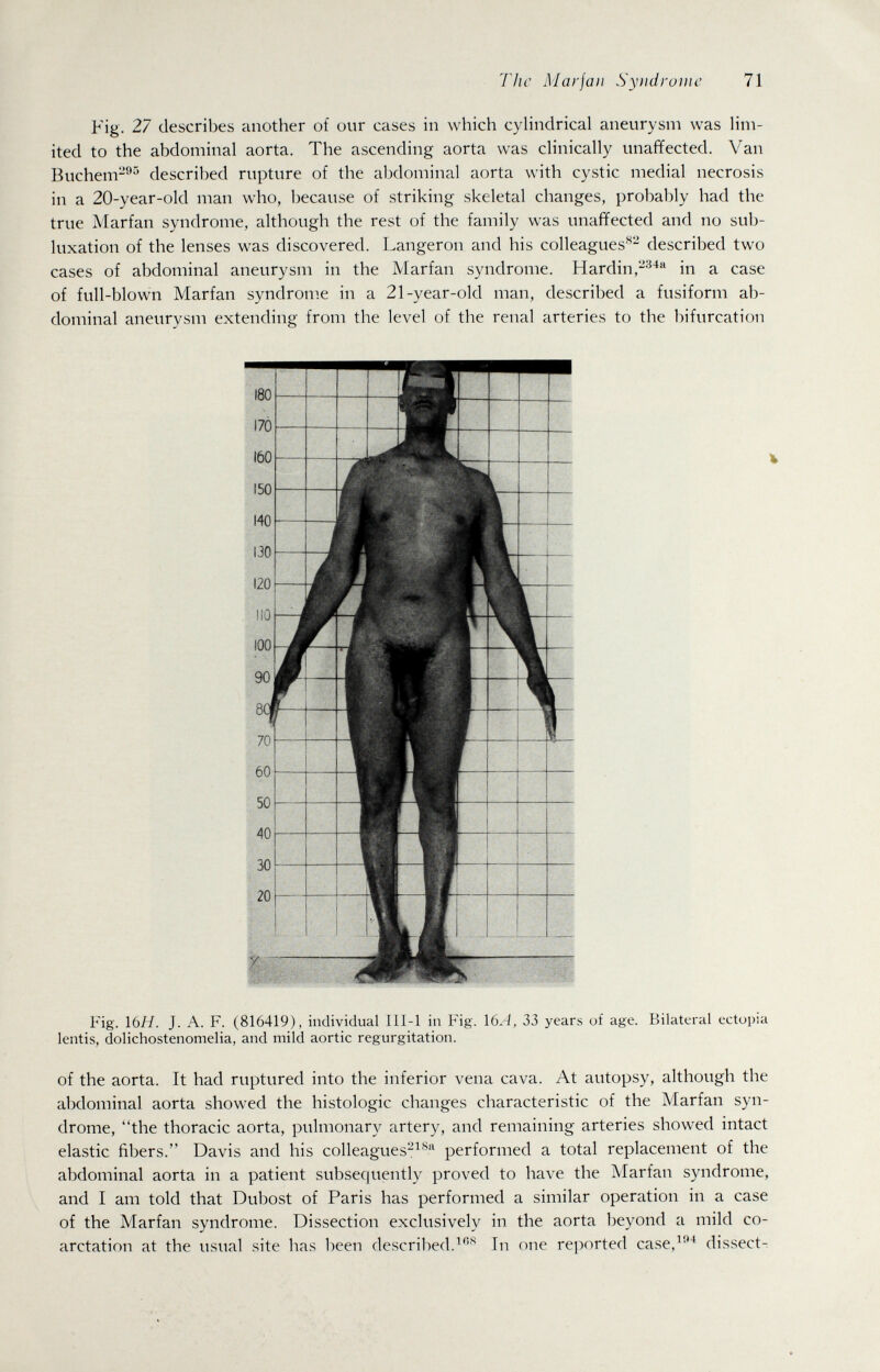 Tìic Marfan Syìidrume 71 Fig. 27 describes another of our cases in which cyHndrical aneurysm was lim¬ ited to the abdominal aorta. The ascending aorta was clinically unaffected. Van Buchem-^^ described rupture of the abdominal aorta with cystic medial necrosis in a 20-year-old man who, because of striking skeletal changes, probably had the true Marfan syndrome, although the rest of the family was unaffected and no sub¬ luxation of the lenses was discovered. Langeron and his colleagues^- described two cases of abdominal aneurysni in the Marfan syndrome. Hardin,in a case of full-blown Marfan syndrome in a 21-year-old man, described a fusiform ab¬ dominal aneurysm extending from the level of the renal arteries to the bifurcation Fig. \ЬН. J. A. F. (816419), individual III-l in Fig. 16A, 33 years of age. Bilateral ectopia lentis, dolichostenornelia, and mild aortic regurgitation. of the aorta. It had ruptured into the inferior vena cava. At autopsy, although the abdominal aorta showed the histologic changes characteristic of the Marfan syn¬ drome, the thoracic aorta, pulmonary artery, and remaining arteries showed intact elastic fibers. Davis and his colleagues-^performed a total replacement of the abdominal aorta in a patient subsequently proved to have the Marfan syndrome, and I am told that Dubost of Paris has performed a similar operation in a case of the Marfan syndrome. Dissection exclusively in the aorta beyond a mild co¬ arctation at the usual site has been described.In one reported case,^'* dissect-