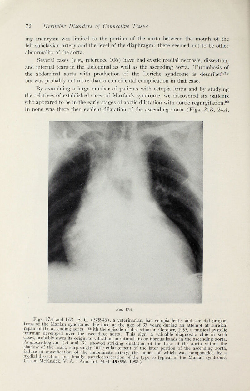 72 Heritable Disorders of Connective Tissvc ing aneurysm was limited to the portion of the aorta between the mouth of the left subclavian artery and the level of the diaphragm ; there seemed not to be other abnormality of the aorta. Several cases (e.g., reference 106) have had cystic medial necrosis, dissection, and internal tears in the abdominal as well as the ascending aorta. Thrombosis of the abdominal aorta with production of the Leriche syndrome is described^^® but was probably not more than a coincidental complication in that case. By examining a large number of patients with ectopia lentis and by studying the relatives of established cases of Marfan's syndrome, we discovered six patients who appeared to be in the early stages of aortic dilatation with aortic regurgitation. In none was there then evident dilatation of the ascending aorta (Figs. 2\B, 2AA, Fig. \1A. Figs. \1 A and 17ß. S. С. (575946), a veterinarian, had ectopia lentis and skeletal propor¬ tions of the Marfan syndrome. He died at the age of 37 years during an attempt at surgical repair of the ascending aorta. With the episode of dissection in October, 1955, a musical systolic murmur developed over the ascending aorta. This sign, a valuable diagnostic clue in such cases, probably owes its origin to vibration in intimai lip or fibrous bands in the ascending aorta. Angiocardiogram (A and ß) showed striking dilatation of the base of the aorta within the shadow of the heart, surpisingly little enlargement of the later portion of the ascending aorta, failure of opacification of the innominate artery, the lumen of which was tamponaded by a medial dissection, and, finally, pseudocoarctation of the type so typical of the Marfan syndrome. (From McKusick, V. A.: Ann. Int. Med. 49:556, 1958.)
