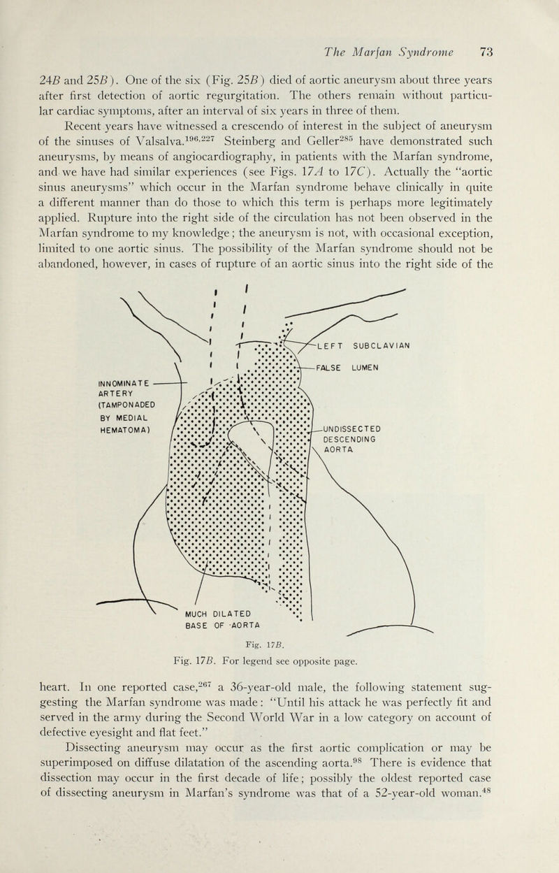 The Mar jan Syndrome 73 2AB and 255). One of the six (Fig. 255) died of aortic aneurysm about three years after first detection of aortic regurgitation. The others remain without particu¬ lar cardiac symptoms, after an interval of six years in three of them. Recent years have witnessed a crescendo of interest in the subject of aneurysm of the sinuses of Valsalva.^^^'^^^ Steinberg and Geller^®*'' have demonstrated such aneurysms, by means of angiocardiography, in patients with the Marfan syndrome, and we have had similar experiences (see Figs. \7A to 17C). Actually the aortic sinus aneurysms which occur in the Marfan syndrome behave clinically in quite a different manner than do those to which this term is perhaps more legitimately applied. Rupture into the right side of the circulation has not been observed in the Marfan syndrome to my knowledge ; the aneurysm is not, with occasional exception, limited to one aortic sinus. The possibility of the Marfan syndrome should not be a1)andoned, however, in cases of rupture of an aortic sinus into the right side of the Fig. 175. For legend see opposite page. heart. In one reported case,^®^ a 36-year-old male, the following statement sug¬ gesting the Marfan syndrome was made : Until his attack he was perfectly fit and served in the army during the Second World War in a low category on account of defective eyesight and flat feet. Dissecting aneurysm may occur as the first aortic complication or may be superimposed on diffuse dilatation of the ascending aorta.®® There is evidence that dissection may occur in the first decade of life; possibly the oldest reported case of dissecting aneurysm in Marfan's syndrome was that of a 52-year-old woman.