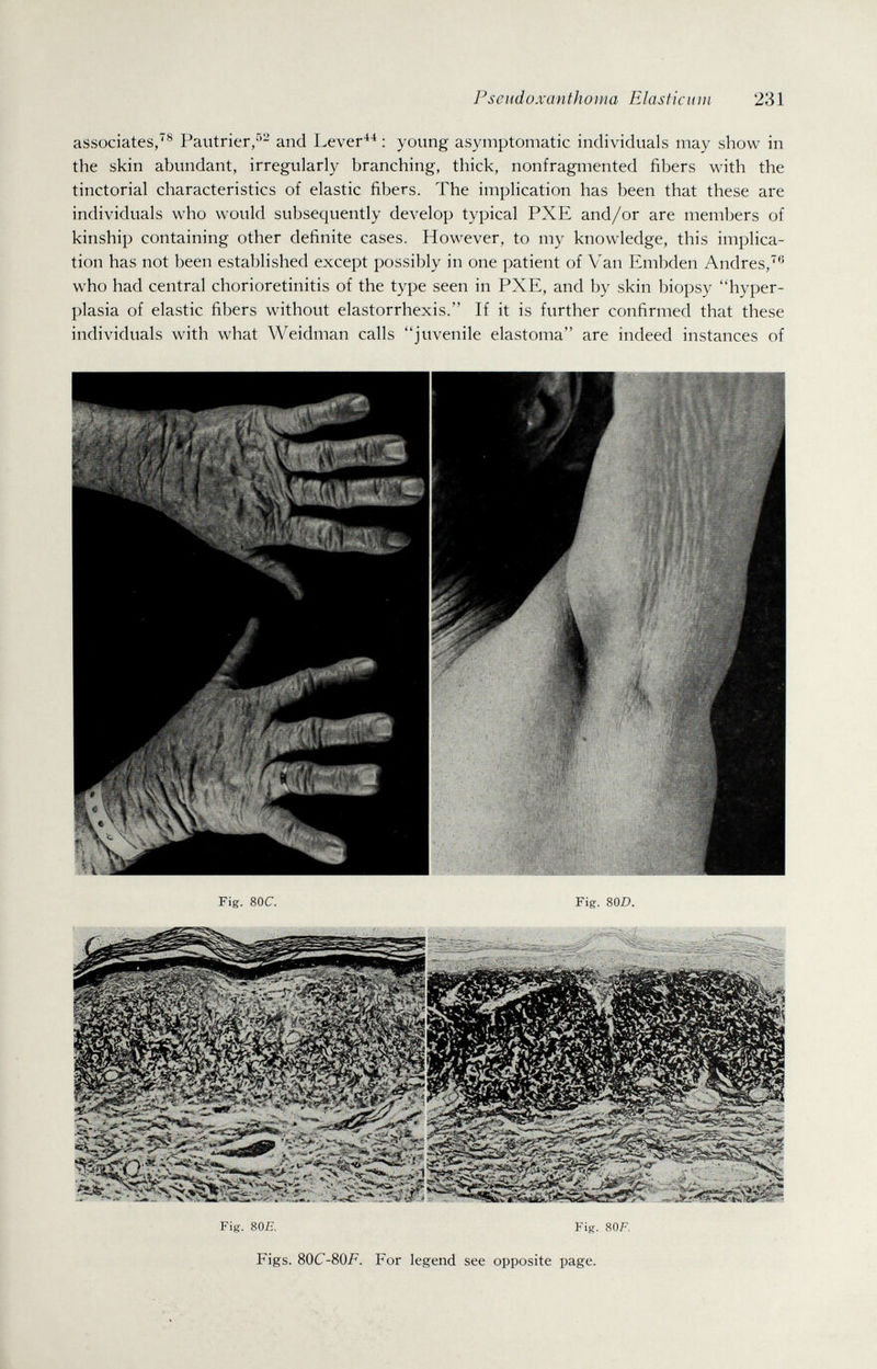 Pseudoxanthoma Elasticum 231 associates/® Pautrier,^^ and Lever^^ : young asymptomatic individuals may show in the skin abundant, irregularly branching, thick, nonfragmented fibers with the tinctorial characteristics of elastic fibers. The implication has been that these are individuals who would subsequently develop typical PXE and/or are members of kinship containing other definite cases. However, to my knowledge, this implica¬ tion has not been established except possibly in one patient of Van Embden Andres,'^*^ who had central chorioretinitis of the type seen in PXE, and by skin biopsy hyper¬ plasia of elastic fibers without elastorrhexis. If it is further confirmed that these individuals with what Weidman calls juvenile elastoma are indeed instances of Fig. 80Я Fig. 80F. Figs. 80C-80F. For legend see opposite page.