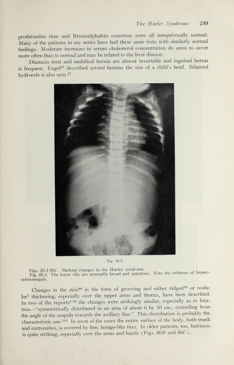 The Hurler Syndrome 249 prothrombin time and Bromsulphalein excertion were all unequivocally normal. Many of the patients in my series have had these same tests with similarly normal findings. Moderate increases in serum cholesterol concentration do seem to occur more often than is normal and may be related to the liver disease. Diastasis recti and umbilical hernia are almost invariable and inguinal hernia is frequent. EngeF^ described scrotal hernias the size of a child's head. Bilateral hydrocele is also seen.^^ Fig. &5A. Figs. 85Л-85С. Skeletal changes in the Hurler syndrome. Fig. 85A. The lower ribs are unusually broad and spatulous. Note the evidence of hepato- splenomegaly. Changes in the skin^ in the form of grooving and either ridged^'^ or nodu¬ lar^ thickening, especially over the upper arms and thorax, have been described. In two of the reports^'^'^ the changes were strikingly similar, especially as to loca¬ tion—symmetrically distributed in an area of about 6 by 10 cm., extending from the angle of the scapula towards the axillary line. This distribution is probably the characteristic one.^^'' In most of the cases the entire surface of the body, both- trunk and extremities, is covered by fine, lanugo-like fuzz. In older patients, too, hairiness is quite striking, especially over the arms and hands (Figs. 86B and 86C).