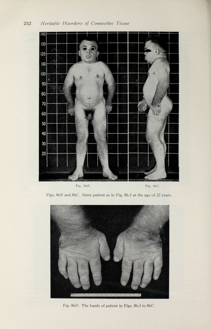 Heritable Disorders of Connective Tissue Fig. 86B. Fig. 86C. Figs. 867? and 86C. Same patient as in Fig. 86A at the age of 22 years. Я ♦íV Fig. 86D. The hands of patient in Figs. 86A to 86C.