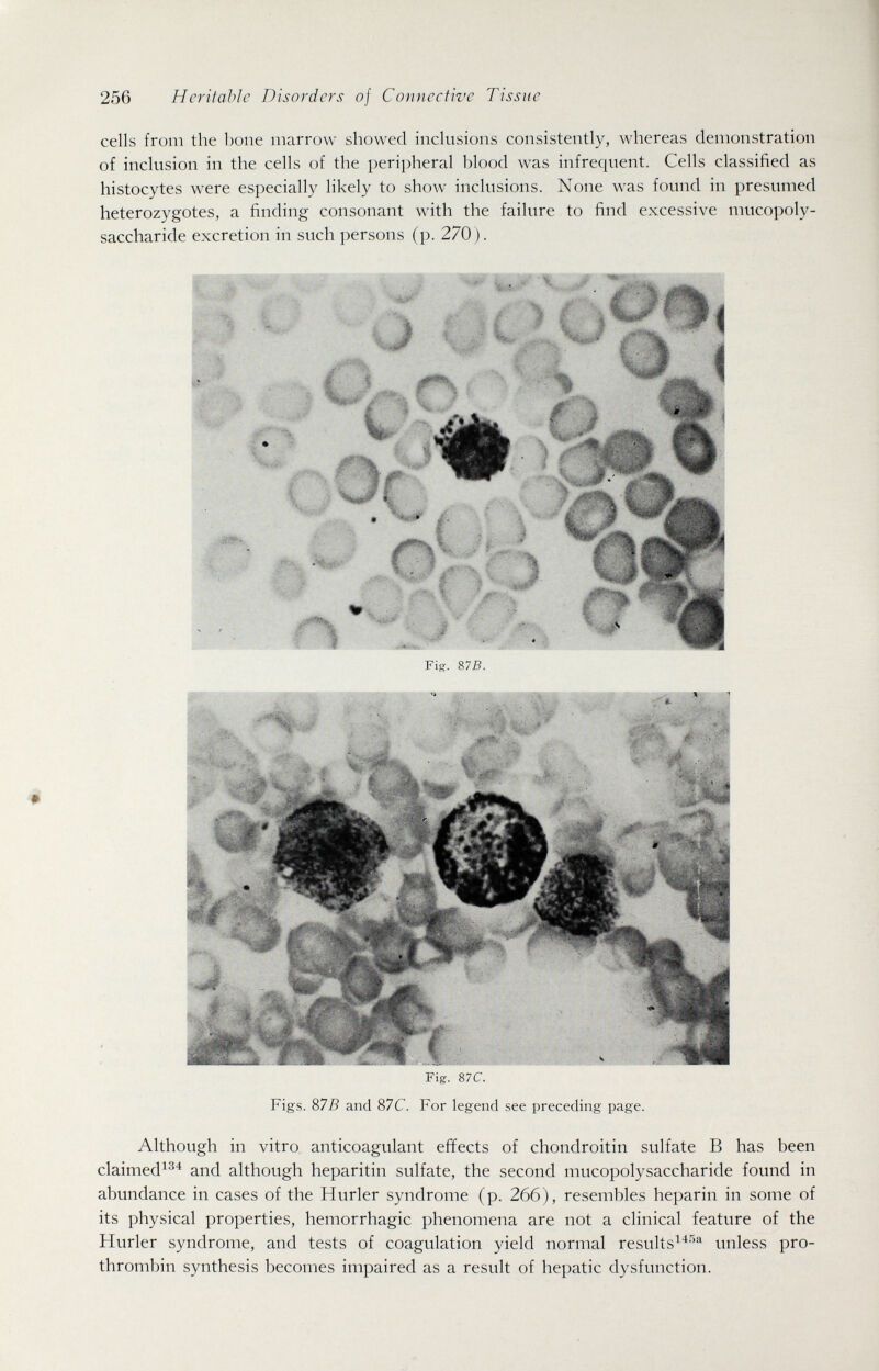 256 Heritable Disorders of Connective Tissue cells from the bone marrow showed inclusions consistently, whereas demonstration of inclusion in the cells of the peripheral blood was infrequent. Cells classified as histocytes were especially likely to show inclusions. None was found in presumed heterozygotes, a finding consonant with the failure to find excessive mucopoly¬ saccharide excretion in such persons (p. 270). Fig. 87C. Figs. S7B and 87C. For legend see preceding page. Although in vitro anticoagulant effects of chondroitin sulfate В has been claimed^^'^ and although heparitin sulfate, the second mucopolysaccharide found in abundance in cases of the Hurler syndrome (p. 266), resembles heparin in some of its physical properties, hemorrhagic phenomena are not a clinical feature of the Hurler syndrome, and tests of coagulation yield normal results^■^•''^ unless pro¬ thrombin synthesis becomes impaired as a result of hepatic dysfunction.