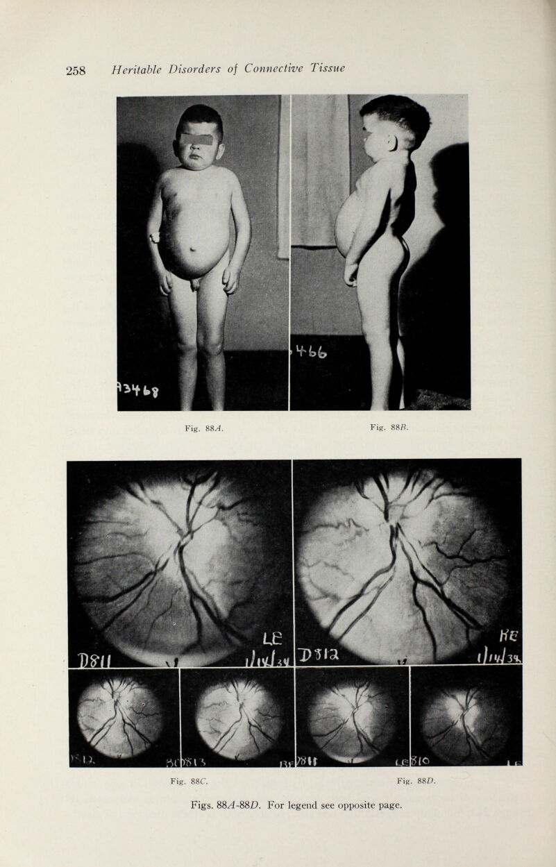 258 Heritable Disorders of Connective Tissue Fír. 88C. P^ig. 88D. Figs. 88A-88D. For legend see opposite page.