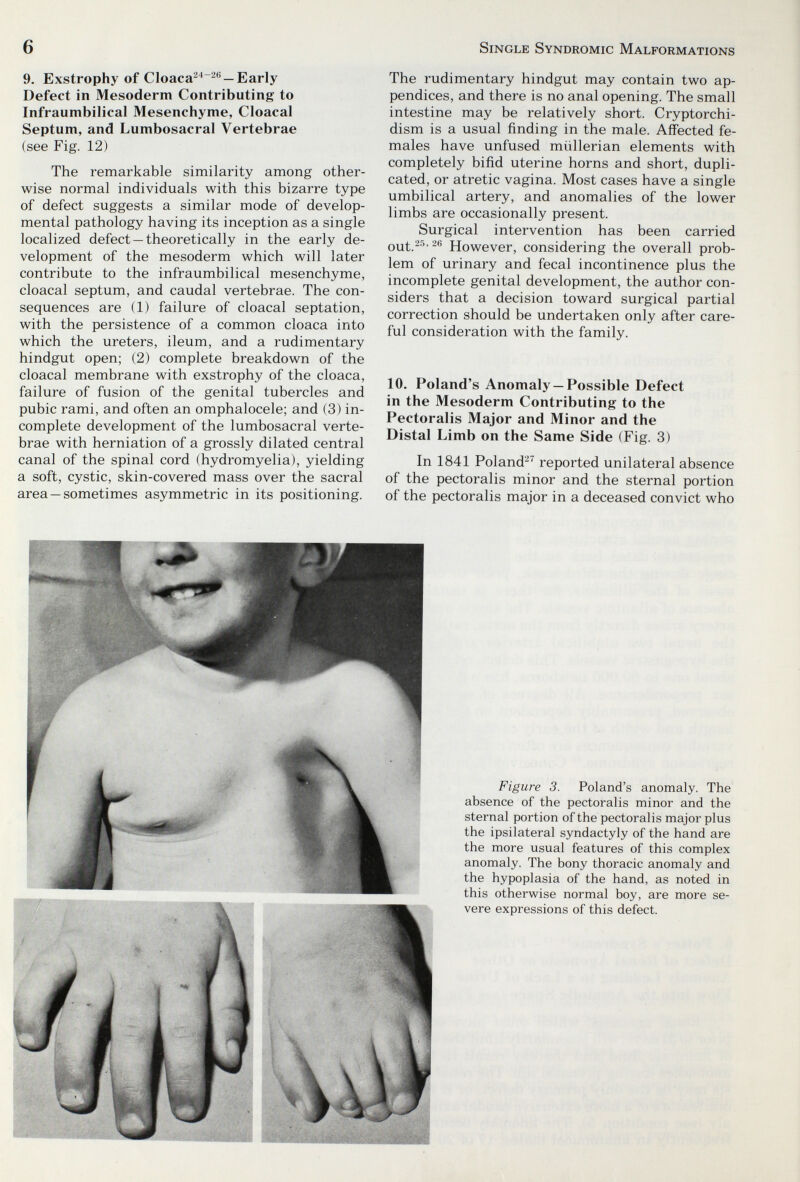 6 Single Syndromic Malformations 9. Exstrophy of Cloaca^'*^'' —Early Defect in Mesoderm Contributing to Infraumbilical Mesenchyme, Cloacal Septum, and Lumbosacral Vertebrae (see Fig. 12) The remarkable similarity among other¬ wise normal individuals with this bizarre type of defect suggests a similar mode of develop¬ mental pathology having its inception as a single localized defect —theoretically in the early de¬ velopment of the mesoderm which will later contribute to the infraumbilical mesenchyme, cloacal septum, and caudal vertebrae. The con¬ sequences are (1) failure of cloacal septation, with the persistence of a common cloaca into which the ureters, ileum, and a rudimentary hindgut open; (2) complete breakdown of the cloacal membrane with exstrophy of the cloaca, failure of fusion of the genital tubercles and pubic rami, and often an omphalocele; and (3) in¬ complete development of the lumbosacral verte¬ brae with herniation of a grossly dilated central canal of the spinal cord (hydromyelia), yielding a soft, cystic, skin-covered mass over the sacral area —sometimes asymmetric in its positioning. The rudimentary hindgut may contain two ap¬ pendices, and there is no anal opening. The small intestine may be relatively short. Cryptorchi¬ dism is a usual finding in the male. Affected fe¬ males have unfused miillerian elements with completely bifid uterine horns and short, dupli¬ cated, or atretic vagina. Most cases have a single umbilical artery, and anomalies of the lower limbs are occasionally present. Surgical intervention has been carried out.25> 2H However, considering the overall prob¬ lem of urinary and fecal incontinence plus the incomplete genital development, the author con¬ siders that a decision toward surgical partial correction should be undertaken only after care¬ ful consideration with the family. 10. Poland's Anomaly—Possible Defect in the Mesoderm Contributing to the Pectoralis Major and Minor and the Distal Limb on the Same Side (Fig. 3) In 1841 Poland^^ reported unilateral absence of the pectoralis minor and the sternal portion of the pectoralis major in a deceased convict who W Figure 3. Poland's anomaly. The absence of the pectoralis minor and the sternal portion of the pectoralis major plus the ipsilateral syndactyly of the hand are the more usual features of this complex anomaly. The bony thoracic anomaly and the hypoplasia of the hand, as noted in this otherwise normal boy, are more se¬ vere expressions of this defect.