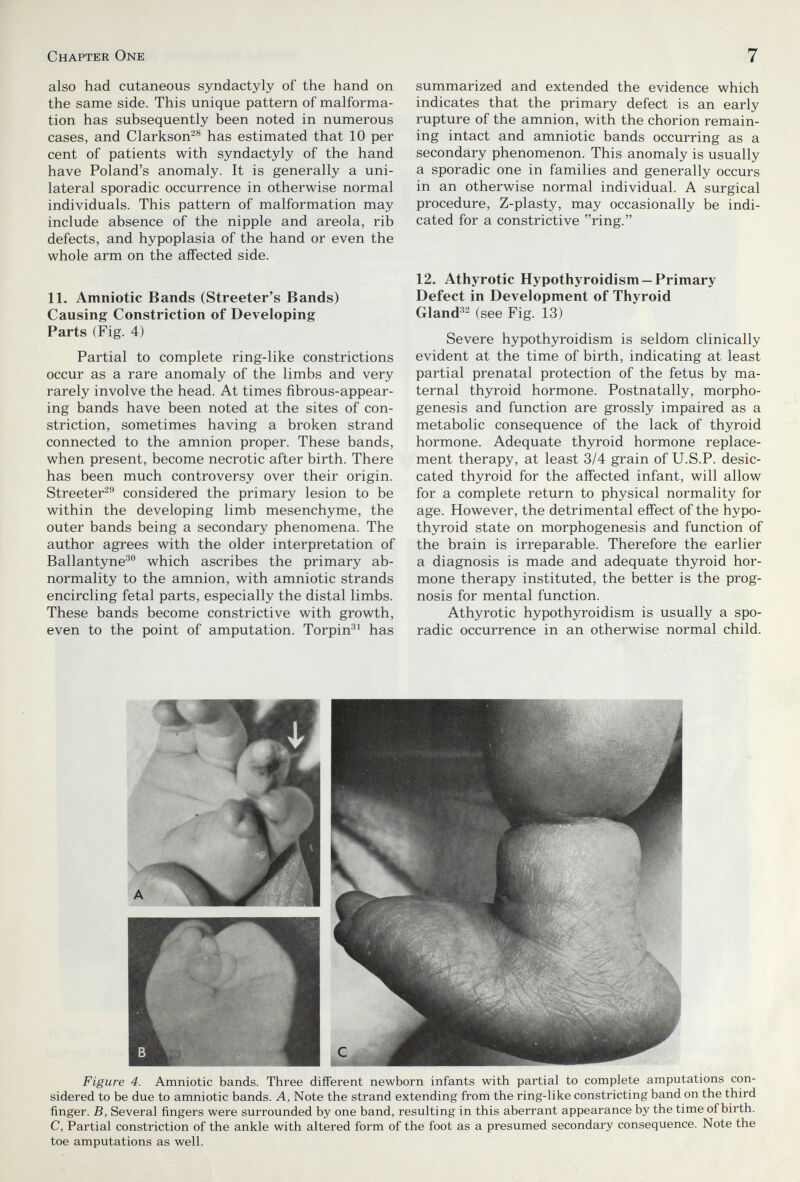 Chapter One 7 also had cutaneous syndactyly of the hand on the same side. This unique pattern of malforma¬ tion has subsequently been noted in numerous cases, and Clarkson^*^ has estimated that 10 per cent of patients with syndactyly of the hand have Poland's anomaly. It is generally a uni¬ lateral sporadic occurrence in otherwise normal individuals. This pattern of malformation may include absence of the nipple and areola, rib defects, and hypoplasia of the hand or even the whole arm on the affected side. 11. Amniotic Bands (Streeter's Bands) Causing Constriction of Developing Parts (Fig. 4) Partial to complete ring-like constrictions occur as a rare anomaly of the limbs and very rarely involve the head. At times fibrous-appear¬ ing bands have been noted at the sites of con¬ striction, sometimes having a broken strand connected to the amnion proper. These bands, when present, become necrotic after birth. There has been much controversy over their origin. Streeter^'' considered the primary lesion to be within the developing limb mesenchyme, the outer bands being a secondary phenomena. The author agrees with the older interpretation of Ballantyne^ which ascribes the primary ab¬ normality to the amnion, with amniotic strands encircling fetal parts, especially the distal limbs. These bands become constrictive with growth, even to the point of amputation. Torpin^' has summarized and extended the evidence which indicates that the primary defect is an early rupture of the amnion, with the chorion remain¬ ing intact and amniotic bands occurring as a secondary phenomenon. This anomaly is usually a sporadic one in families and generally occurs in an otherwise normal individual. A surgical procedure, Z-plasty, may occasionally be indi¬ cated for a constrictive ring. 12. Athyrotic Hypothyroidism —Primary Defect in Development of Thyroid Gland''^ (see Fig. 13) Severe hypothyroidism is seldom clinically evident at the time of birth, indicating at least partial prenatal protection of the fetus by ma¬ ternal thyroid hormone. Postnatally, morpho¬ genesis and function are grossly impaired as a metabolic consequence of the lack of thyroid hormone. Adequate thyroid hormone replace¬ ment therapy, at least 3/4 grain of U.S.P. desic¬ cated thyroid for the affected infant, will allow for a complete return to physical normality for age. However, the detrimental effect of the hypo¬ thyroid state on morphogenesis and function of the brain is irreparable. Therefore the earlier a diagnosis is made and adequate thyroid hor¬ mone therapy instituted, the better is the prog¬ nosis for mental function. Athyrotic hypothyroidism is usually a spo¬ radic occurrence in an otherwise normal child. Figure 4. Amniotic bands. Three different newborn infants with partial to complete amputations con¬ sidered to be due to amniotic bands. A, Note the strand extending from the ring-like constricting band on the third finger. B, Several fingers were surrounded by one band, resulting in this aberrant appearance by the time of birth. C, Partial constriction of the ankle with altered form of the foot as a presumed secondary consequence. Note the toe amputations as well.