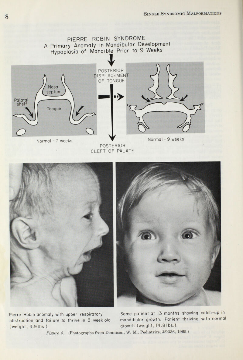 8 Single Syndromic Malformations PIERRE ROBIN SYNDROME A Primary Anomaly in Mandibular Development Hypoplasia of Mandible Prior to 9 Weeks I POSTERIOR DISPLACEMENT OF TONGUE Normal - 7 weeks Normal - 9 weeks POSTERIOR CLEFT OF PALATE Pierre Robin anomaly with upper respiratory obstruction and failure to thrive in 3 week old ( weight, 4.9 lbs,). Same patient at 13 months showing catch-up in mandibular growth. Patient thriving with normal growth (weight, 14.8 lbs.). Figure 5. (Photographs from Dennison, W. M.: Pediatrics, 56:336, 1965.)