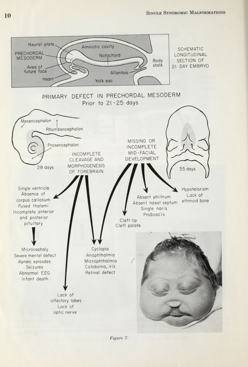 10 Single Syndromic Malformations SCHEMATIC LONGITUDINAL SECTION OF 21 DAY EMBRYO PRIMARY DEFECT IN PRECHORDAL MESODERM Prior to 21 - 25 days 28 days Single ventricle Absence of corpus callosum Fused thalami Incomplete anterior and posterior pituitary INCOMPLETE CLEAVAGE AND MORPHOGENESIS OF FOREBRAIN MISSING OR INCOMPLETE MID-FACIAL DEVELOPMENT I Microcephaly Severe nnental defect Apneic episodes Seizures Abnormal EEG Infant deatti Absent philtrum Absent nasal septum Single naris Proboscis Cleft lip Cleft palate Hypotelorism Lack of ethmoid bone Cyclopia Anophthalmia Microphthalmia Coloboma, iris Retinal defect Lack of olfactory lobes Lack of optic nerve Figure 7.