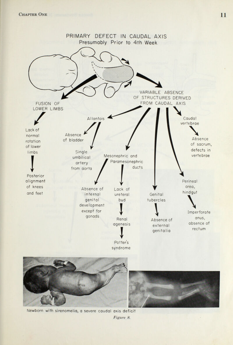 Chapter One PRIMARY DEFECT IN CAUDAL AXIS Presumably Prior to 4th Week FUSION OF LOWER LIMBS VARIABLE ABSENCE OF STRUCTURES DERIVED FROM CAUDAL AXIS / Lack of normal rotation of lower limbs I Posterior alignment of knees and feet Al lantois Absence of bladder Single umbilical artery from aorta Mesonephric and Paramesonephric ducts Absence of internal genital development except for gonads I Lack of ureteral bud I Renal agenesis J Potters syndrome Genital tubercles \ Absence of external genita lia Caudal vertebrae \ Absence of sacrum, defects in vertebrae Perineal area, hindgut \ Imperforate anus, absence of rectum Newborn with sirenomelia, a severe caudal axis deficit Figure 8.