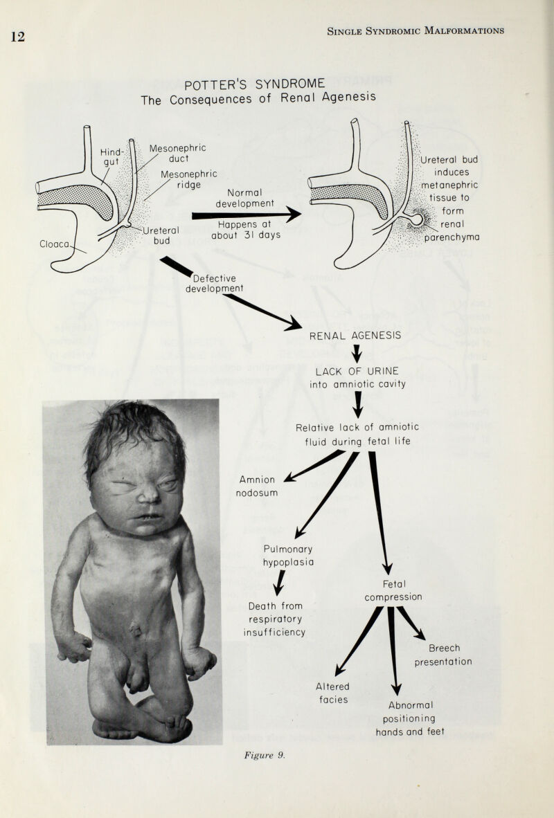 Single Syndromic Malformations POTTER'S SYNDROME The Consequences of Renal Agenesis ■. Mesonephric duct Mesonephric ridge vi:Ureteral bud Normal development Happens at about 31 days Defective development •^Ureteral bud induces •/rnetanephric tissue to fei form renal ^ilKparenchyma RENAL AGENESIS Amnion nodosum LACK OF URINE into amniotic cavity I Relative lack of amniotic fluid during fetal life Pulmonary hypoplasia Death from respiratory insufficiency Altered facies Fetal compression Breech presentation Abnormal positioning hands and feet Figure 9.