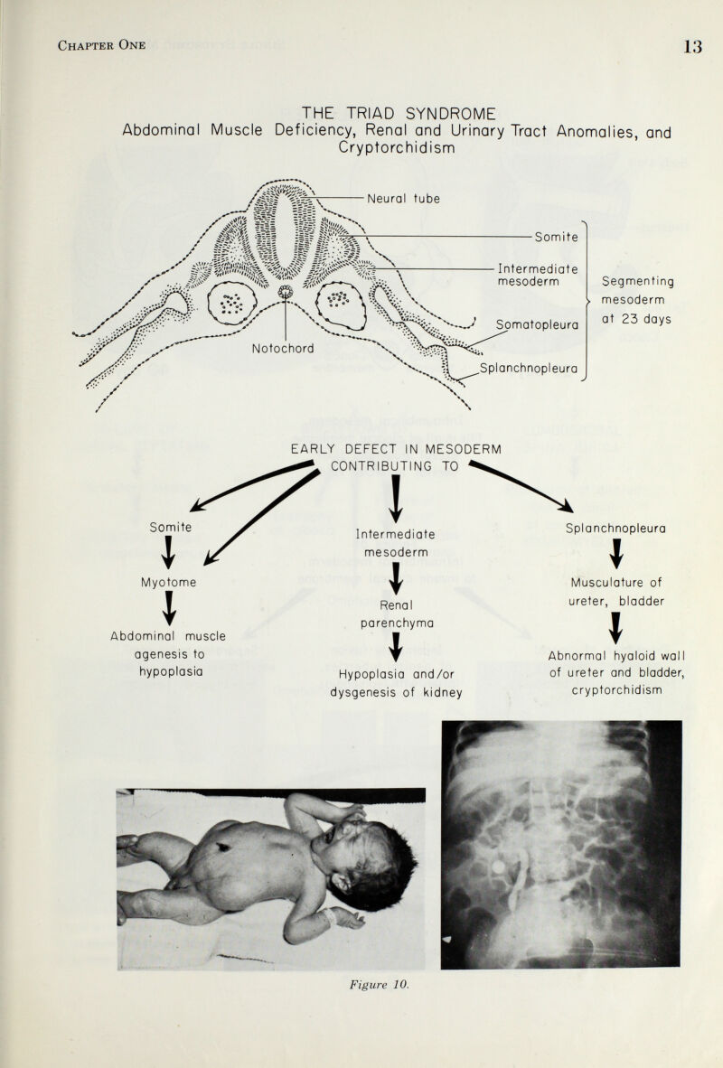 Chapter One 13 THE TRIAD SYNDROME Abdominal Muscle Deficiency, Renal and Urinary Tract Anomalies, and Cryptorchidism Neural tube I^V^\ Notochord ■Somite Intermediate mesoderm Somatopleura Splanchnopleura Segmenting mesoderm at 23 days Somite 1 Myotome t Abdominal muscle agenesis to hypoplasia EARLY DEFECT IN MESODERM CONTRIBUTING TO Î Intermediate mesoderm I Renal parenchyma I Hypoplasia and/or dysgenesis of kidney Splanchnopleura I Musculature of ureter, bladder » Abnormal hyaloid wall of ureter and bladder, cryptorchidism Figure 10.