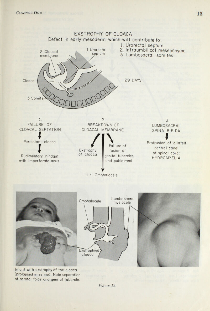 Chapter One 15 Cloaca EXSTROPHY OF CLOACA Defect in early mesoderm which will contribute to: 1. Urorectal septum „p. I , 1.Urorectal 2. Inf raumbi lical mesenchyme membrane ^ septum 5 Lumbosacral somites 29 DAYS 3. Somite 1. FAILURE OF CLOACAL SEPTATION I Persistant cloaca I Rudimentary hindgut with imperforate anus BREAKDOWN OF CLOACAL MEMBRANE Exstrophy of cloaca \ Failure of fusion of genital tubercles and pubic rami +/- Omphalocele LUMBOSACRAL SPINA BIFIDA I Protrusion of dilated central canal of spinal cord: HYDROMYELIA Infant with exstrophy of the cloaca (prolapsed intestine). Note separation of scrotal folds and genital tubercle. Figure 12.