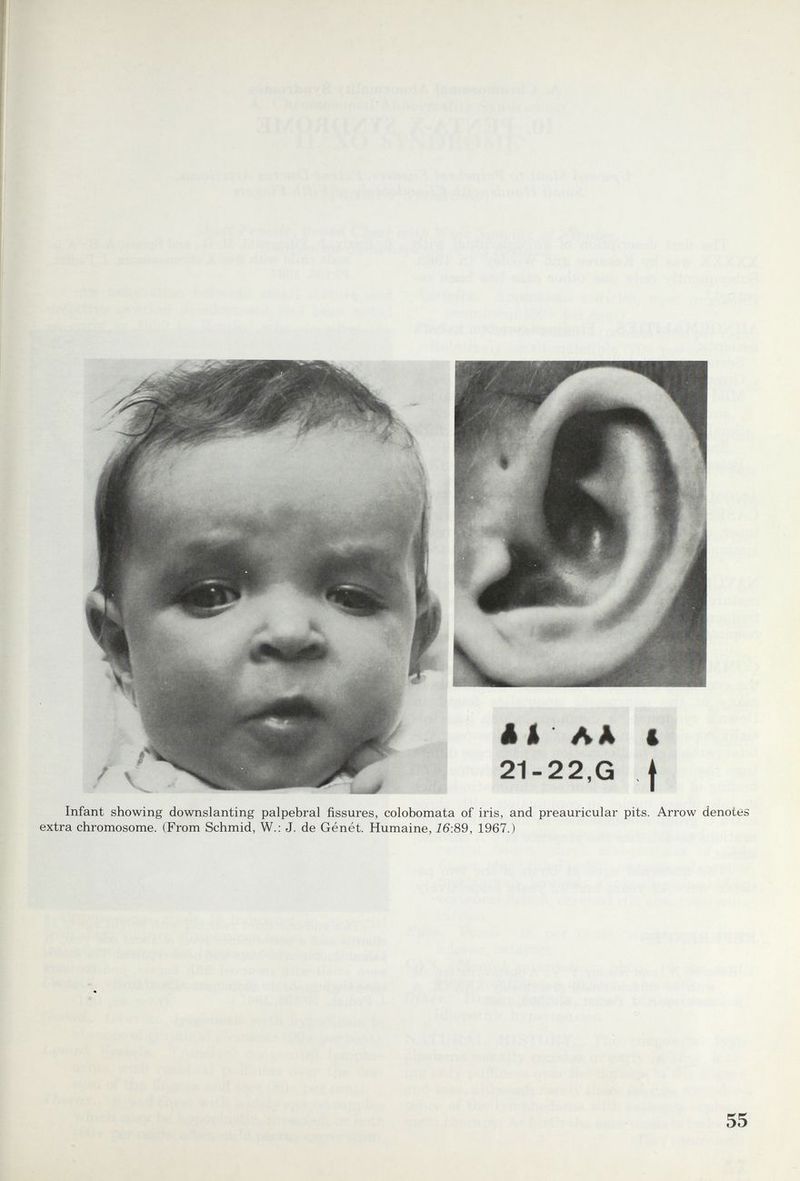 I I Í I i I Infant showing downslanting palpebral fissures, colobomata of iris, and preauricular pits. Arrow denotes extra chromosome. (From Schmid, W.; J. de Génét. Humaine, 16:89, 1967.) 55