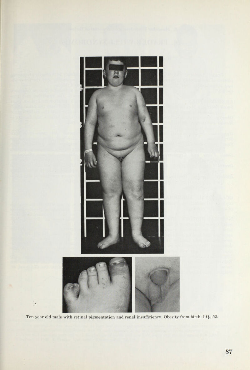 Ten year old male with retinal pigmentation and renal insufficiency. Obesity from birth. I.Q., 52. 87