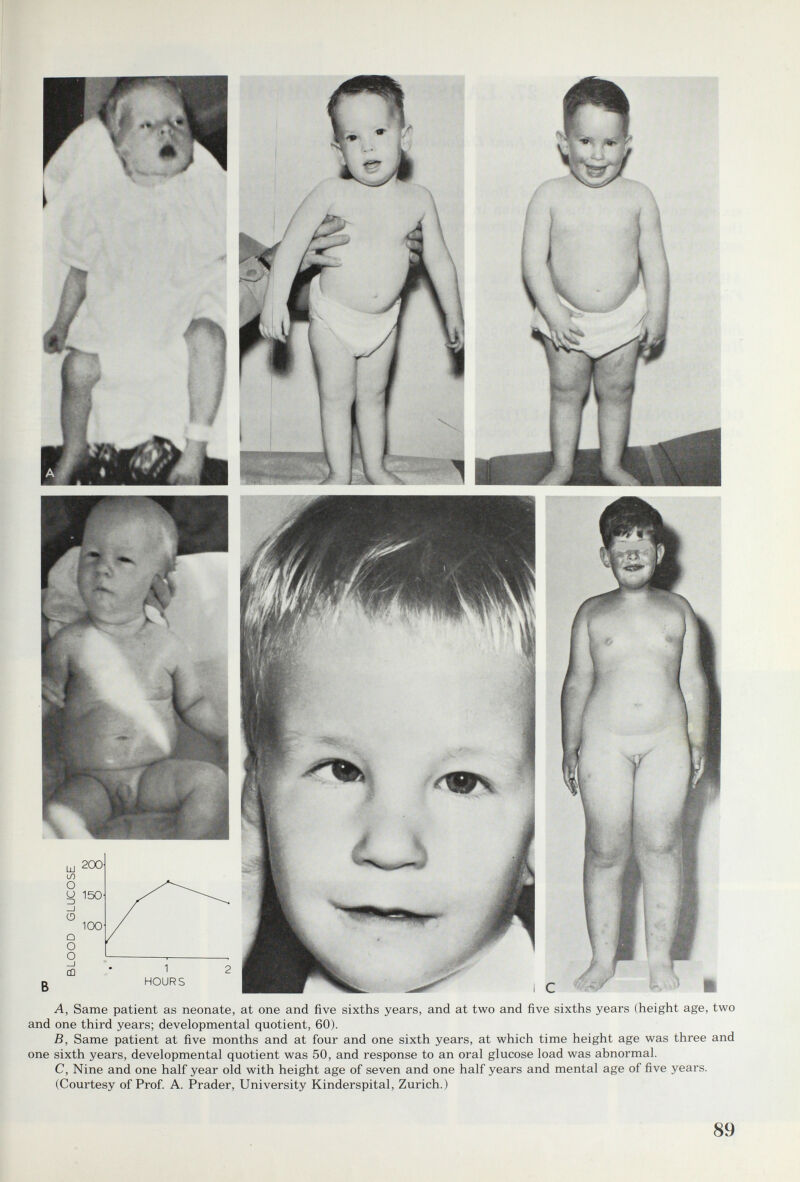 A, Same patient as neonate, at one and five sixths years, and at two and five sixths years (height age, two and one third years; developmental quotient, 60). B, Same patient at five months and at four and one sixth years, at which time height age was three and one sixth years, developmental quotient was 50, and response to an oral glucose load was abnormal. C, Nine and one half year old with height age of seven and one half years and mental age of five years. (Courtesy of Prof A. Prader, University Kinderspital, Zurich.) 89
