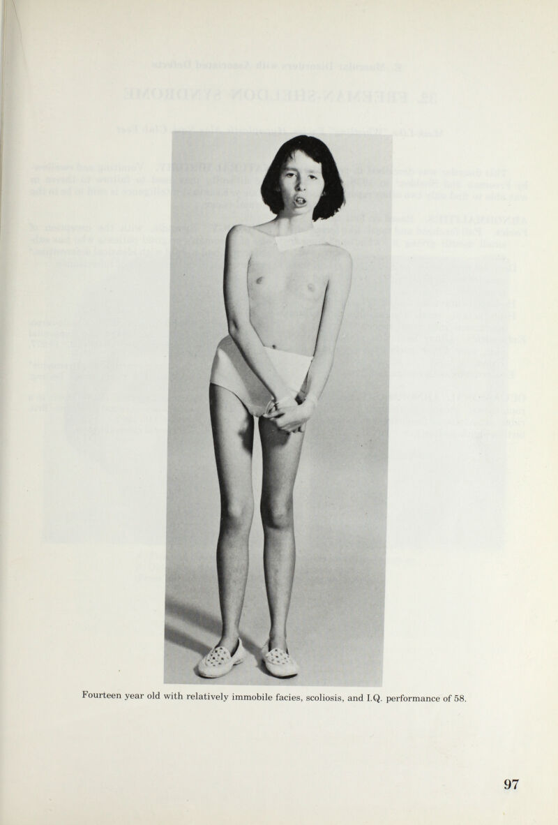 Fourteen year old with relatively immobile facies, scoliosis, and I.Q. performance of 58.