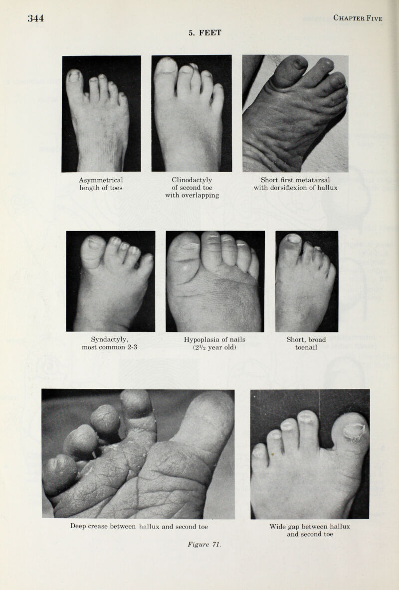 344 5. FEET Chapter Five Asymmetrical length of toes Clinodactyly of second toe with overlapping Short first metatarsal with dorsiñexion of hallux Deep crease between hallux and second toe Wide gap between hallux and second toe Figure 71.