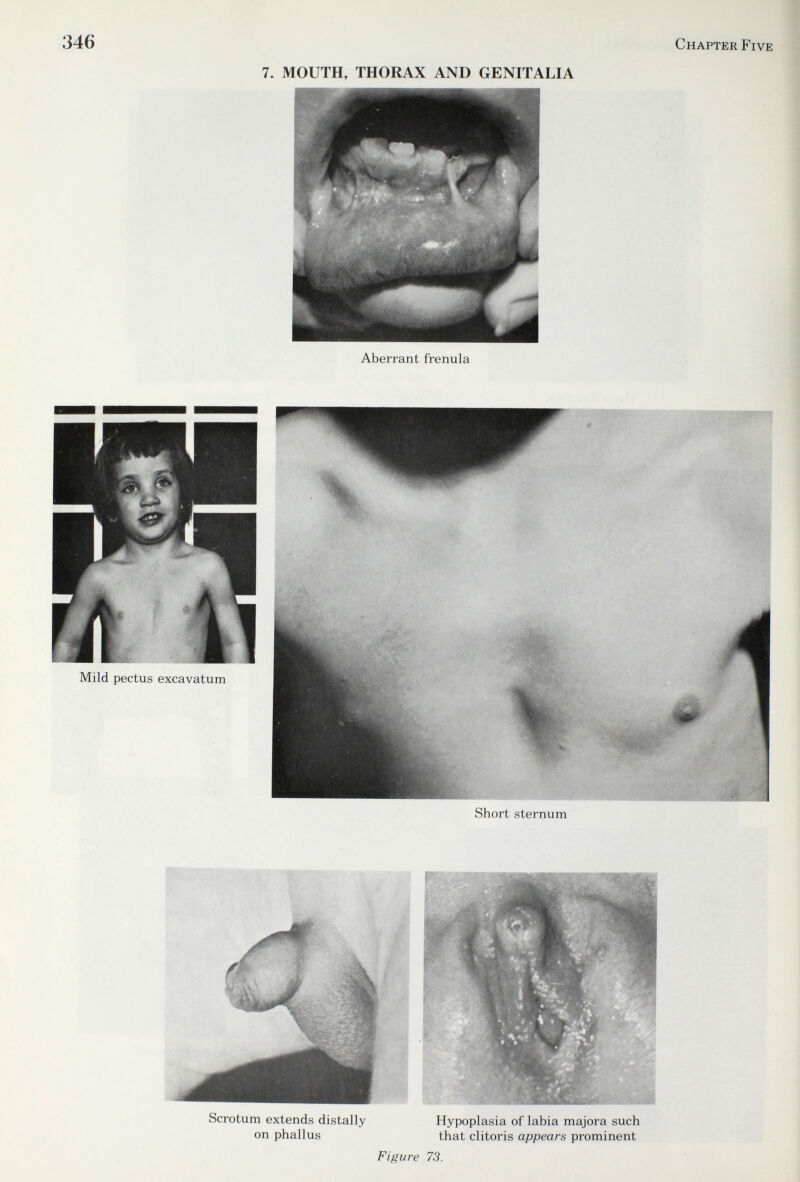 346 Chapter Five 7. MOUTH, THORAX AND GENITALIA Aberrant frenula Short sternum Scrotum extends distally Hypoplasia of labia majora such on phallus that clitoris appears prominent Figure 73.