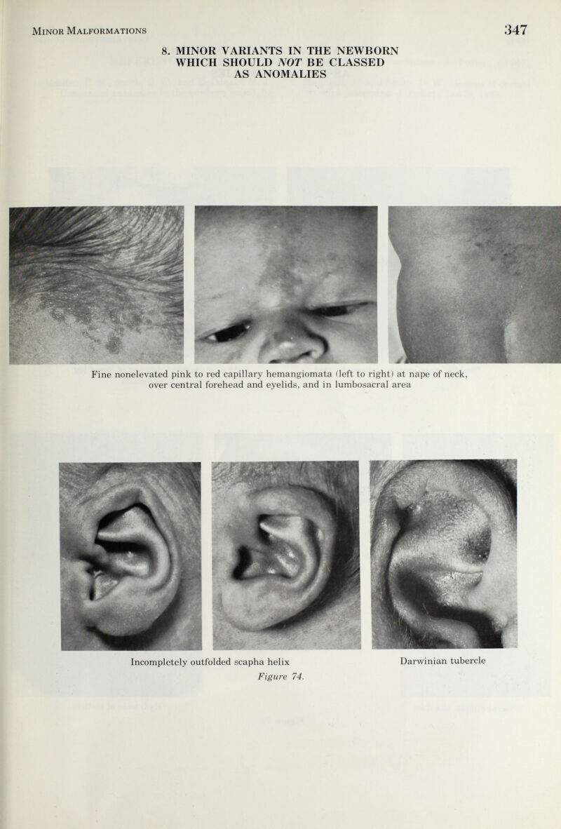 Minor Malformations 8. MINOR VARIANTS IN THE NEWBORN WHICH SHOULD NOT BE CLASSED AS ANOMALIES 347 Fine nonelevated pink to red capillary hemangiomata (left to right) at nape of neck, over central forehead and eyelids, and in lumbosacral area Incompletely outfolded scapha helix Darwinian tubercle Figure 74.