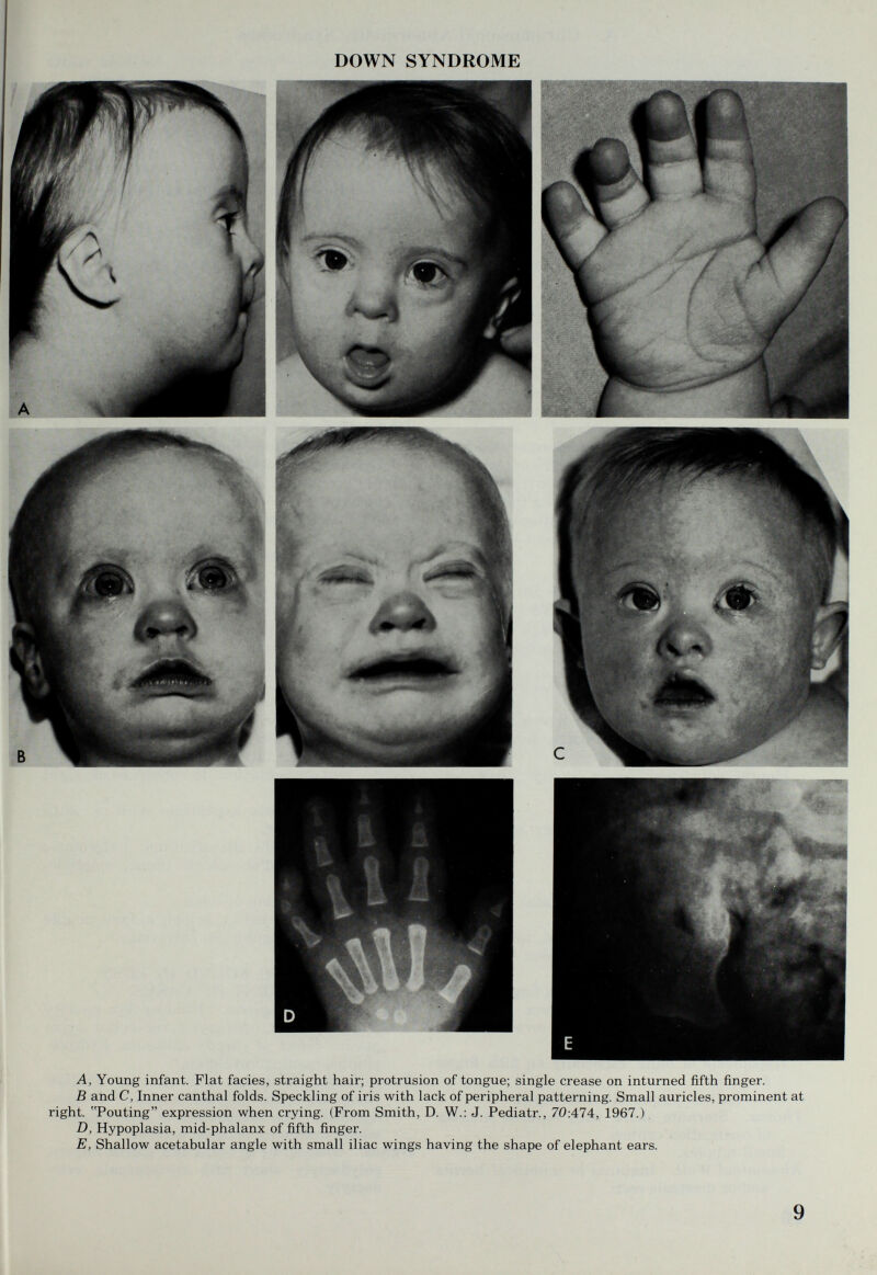 DOWN SYNDROME A, Young infant. Flat facies, straight hair; protrusion of tongue; single crease on inturned fifth finger. В and C, Inner canthal folds. Speckling of iris with lack of peripheral patterning. Small auricles, prominent at right. Pouting expression when crying. (From Smith, D. W.; J. Pediatr., 70:474, 1967.) D, Hypoplasia, mid-phalanx of fifth finger. E, Shallow acetabular angle with small iliac wings having the shape of elephant ears. 9