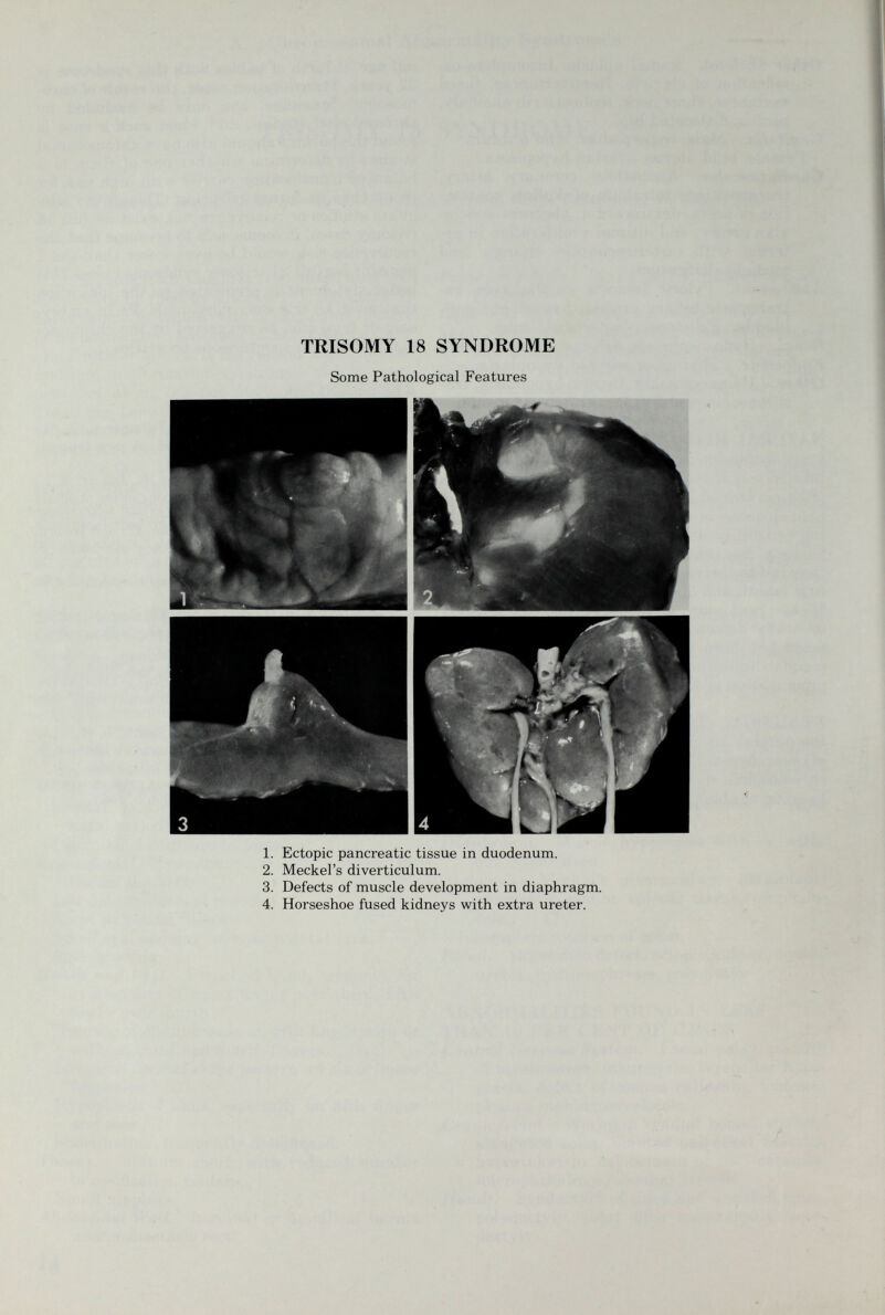 TRISOMY 18 SYNDROME Some Pathological Features 1. Ectopic pancreatic tissue in duodenum. 2. Meckel's diverticulum. 3. Defects of muscle development in diaphragm. 4. Horseshoe fused kidneys with extra ureter.