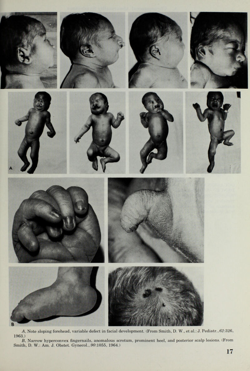 A, Note sloping forehead, variable defect in facial development. (From Smith, D. W., et al.: J. Pediatr., 62:326, 1963.) B, Narrow hyperconvex fingernails, anomalous scrotum, prominent heel, and posterior scalp lesions. (From Smith, D. W.; Am. J. Obstet. Gynecol., 90:1055, 1964.) 17