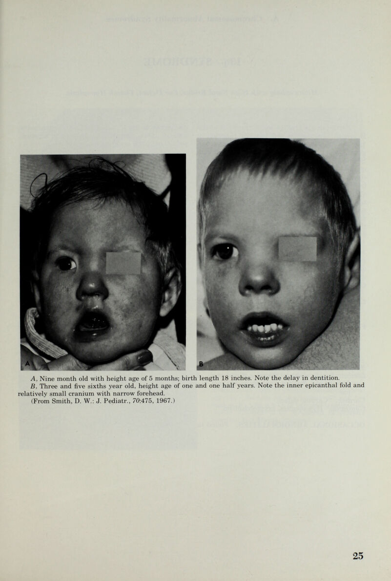 A, Nine month old with height age of 5 months; birth length 18 inches. Note the delay in dentition. B, Three and five sixths year old, height age of one and one half years. Note the inner epicanthal fold and relatively small cranium with narrow forehead. (From Smith, D. W.: J. Pediatr., 70:475, 1967.) 25