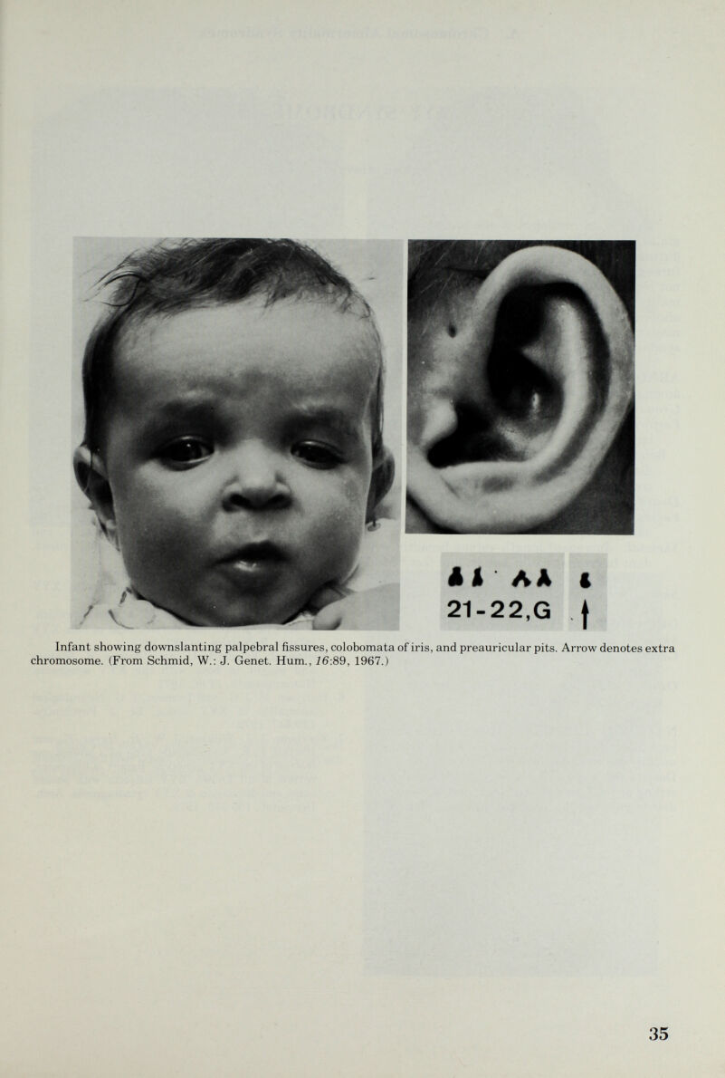 г I Infant showing downslanting palpebral fissures, colobomata of iris, and preauricular pits. Arrow denotes extra chromosome. (From Schmid, W.: J. Genet. Hum., 16:89, 1967.) 35