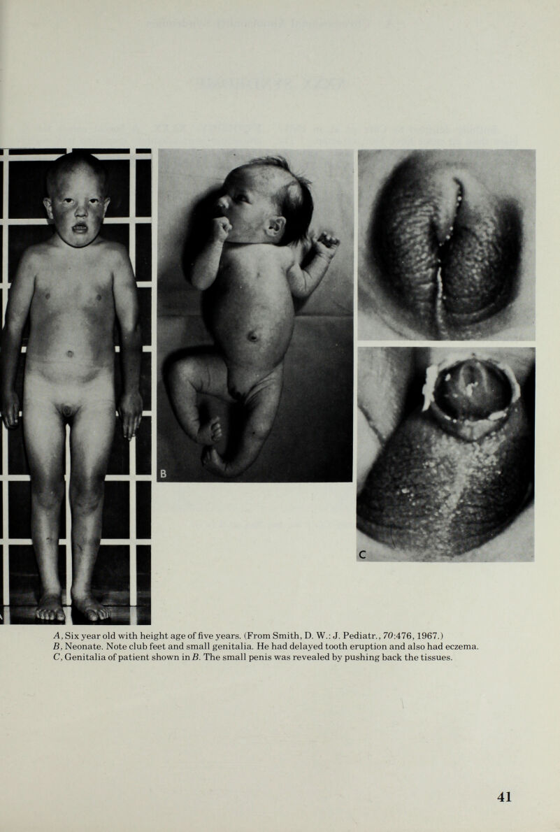 A, Six year old with height age of five years. (From Smith, D. W.: J. Pediatr., 70:476,1967.) B, Neonate. Note club feet and small genitalia. He had delayed tooth eruption and also had eczema. C, Genitalia of patient shown inß. The small penis was revealed by pushing back the tissues. 41